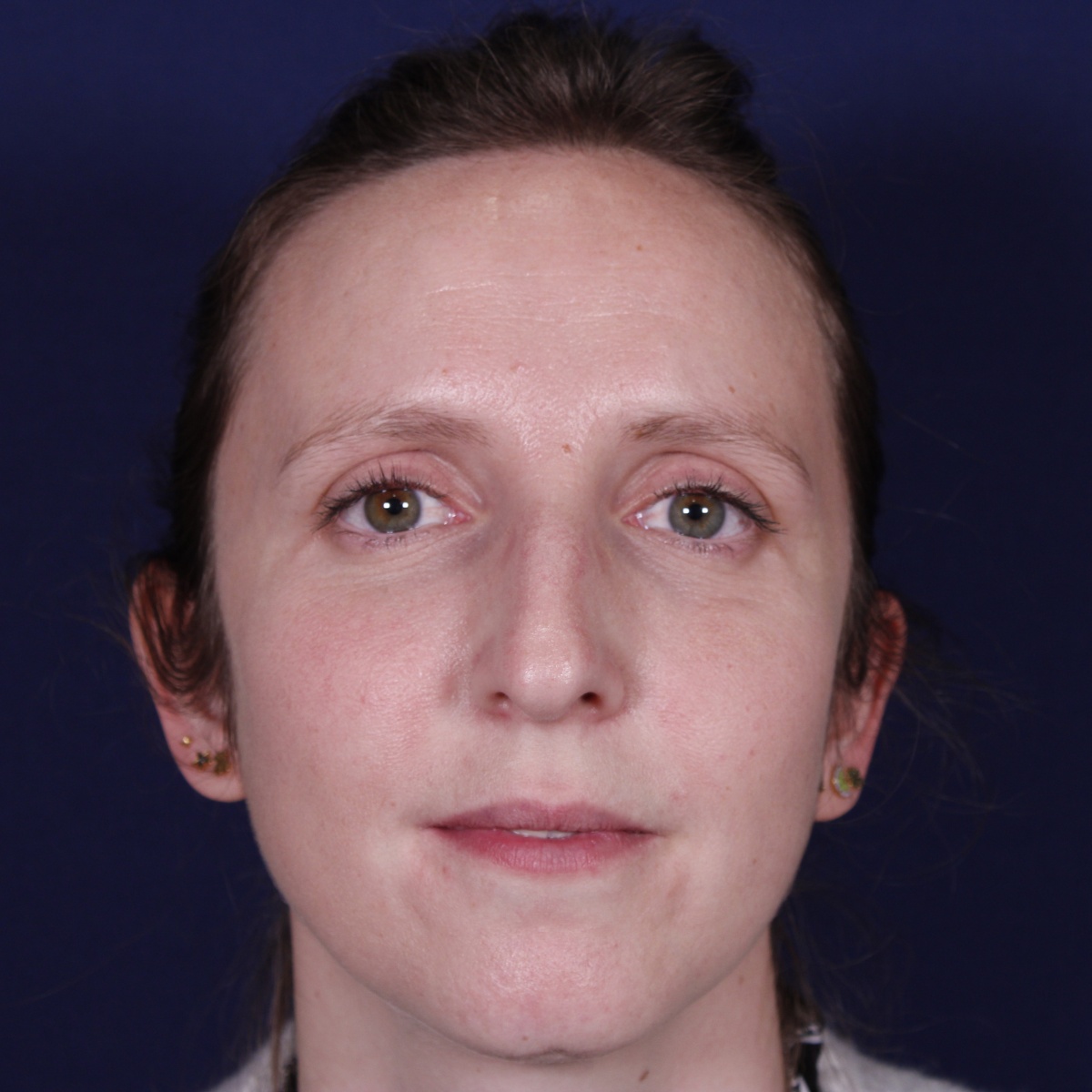 Rinoplastia ultrasónica realizada en paciente joven — antes. Caso operado por el Dr. Gustavo Sordo en Madrid