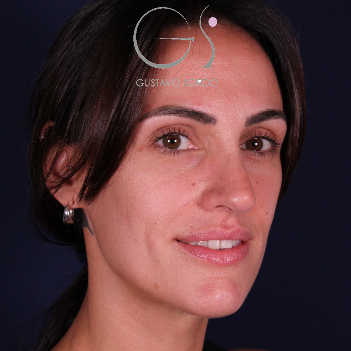 Rinoplastia ultrasónica en mujer con nariz aguileña y larga, punta caída y piel gruesa, después de la operación (6)