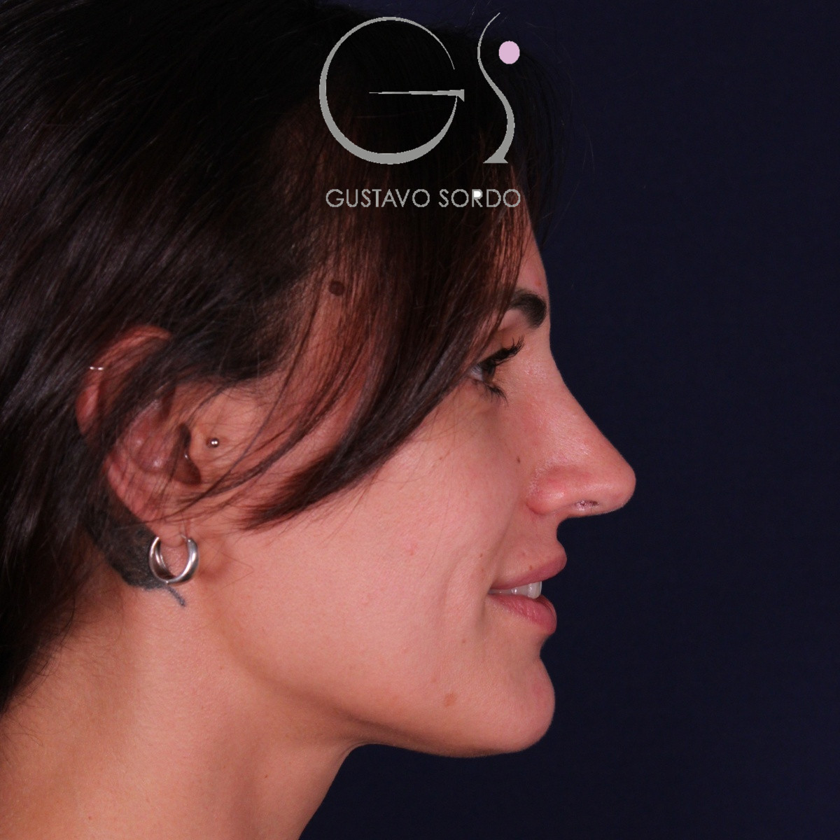 Rinoplastia ultrasónica en mujer con nariz aguileña y larga, punta caída y piel gruesa, después de la operación (4)