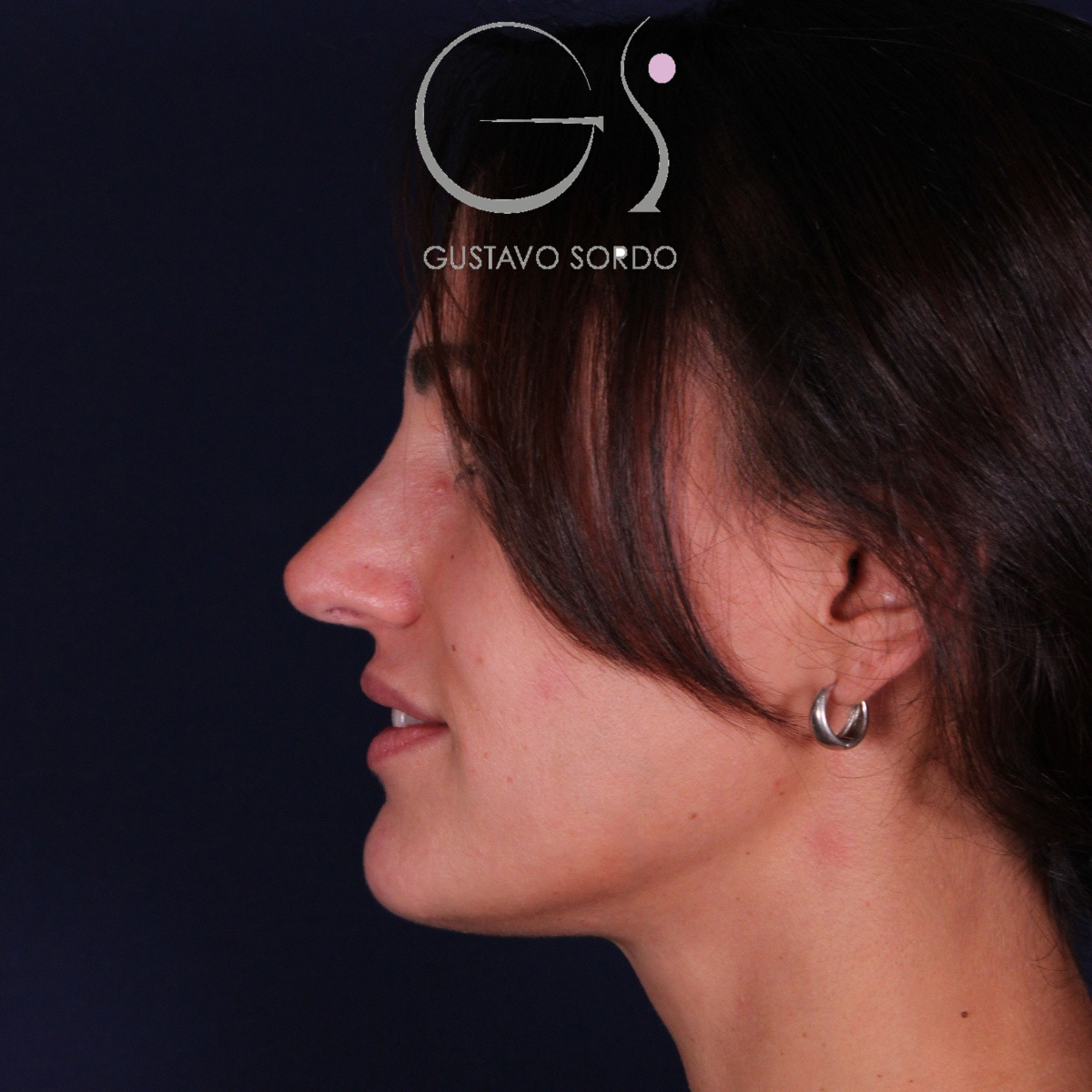 Rinoplastia ultrasónica en mujer con nariz aguileña y larga, punta caída y piel gruesa, después de la operación (5)