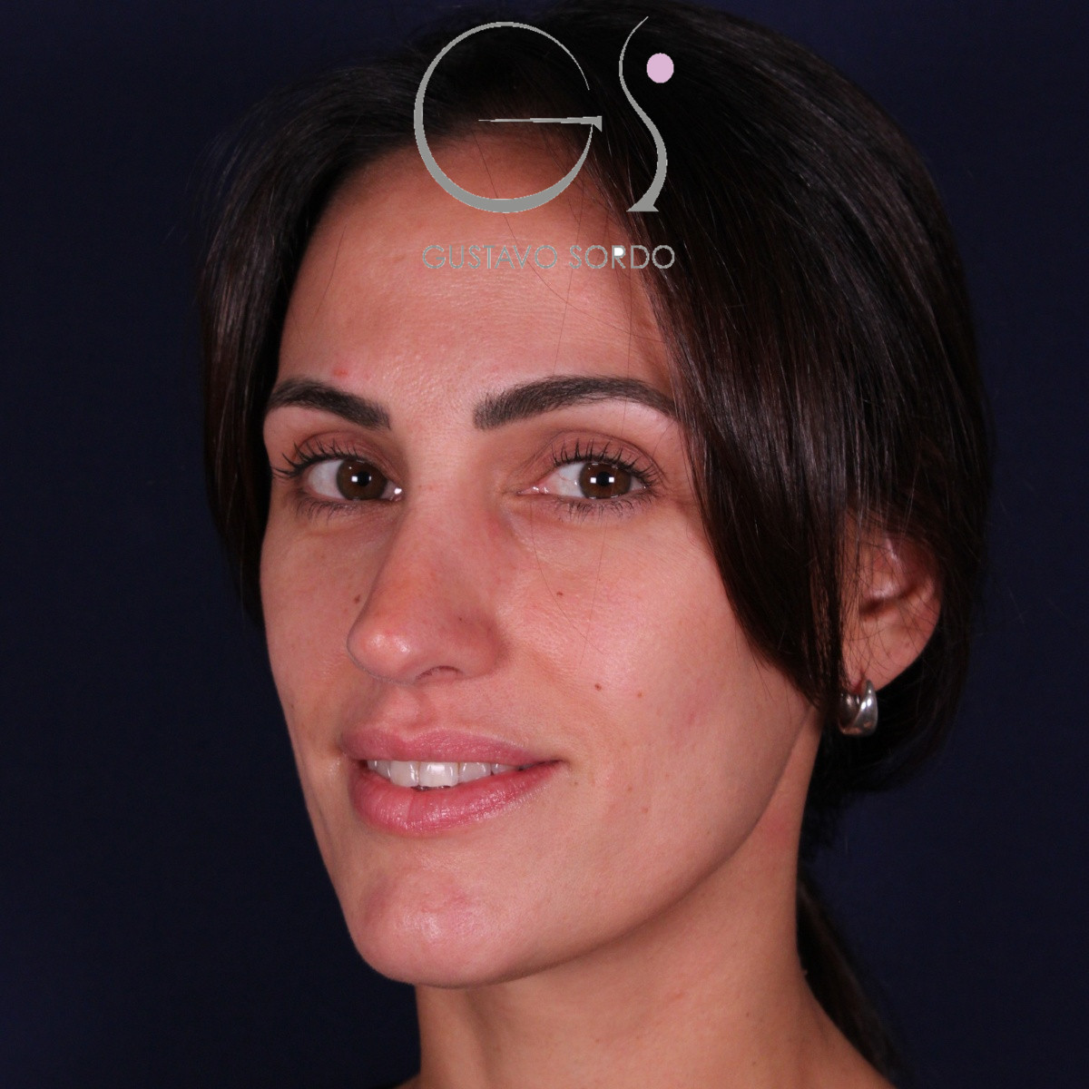 Rinoplastia ultrasónica en mujer con nariz aguileña y larga, punta caída y piel gruesa, después de la operación (7)
