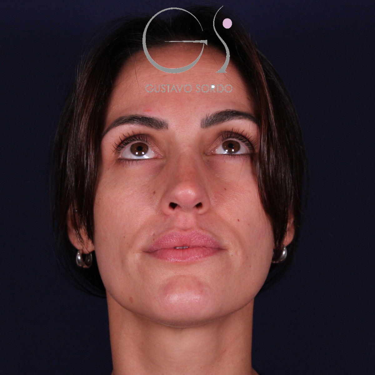 Rinoplastia ultrasónica en mujer con nariz aguileña y larga, punta caída y piel gruesa, después de la operación (3)