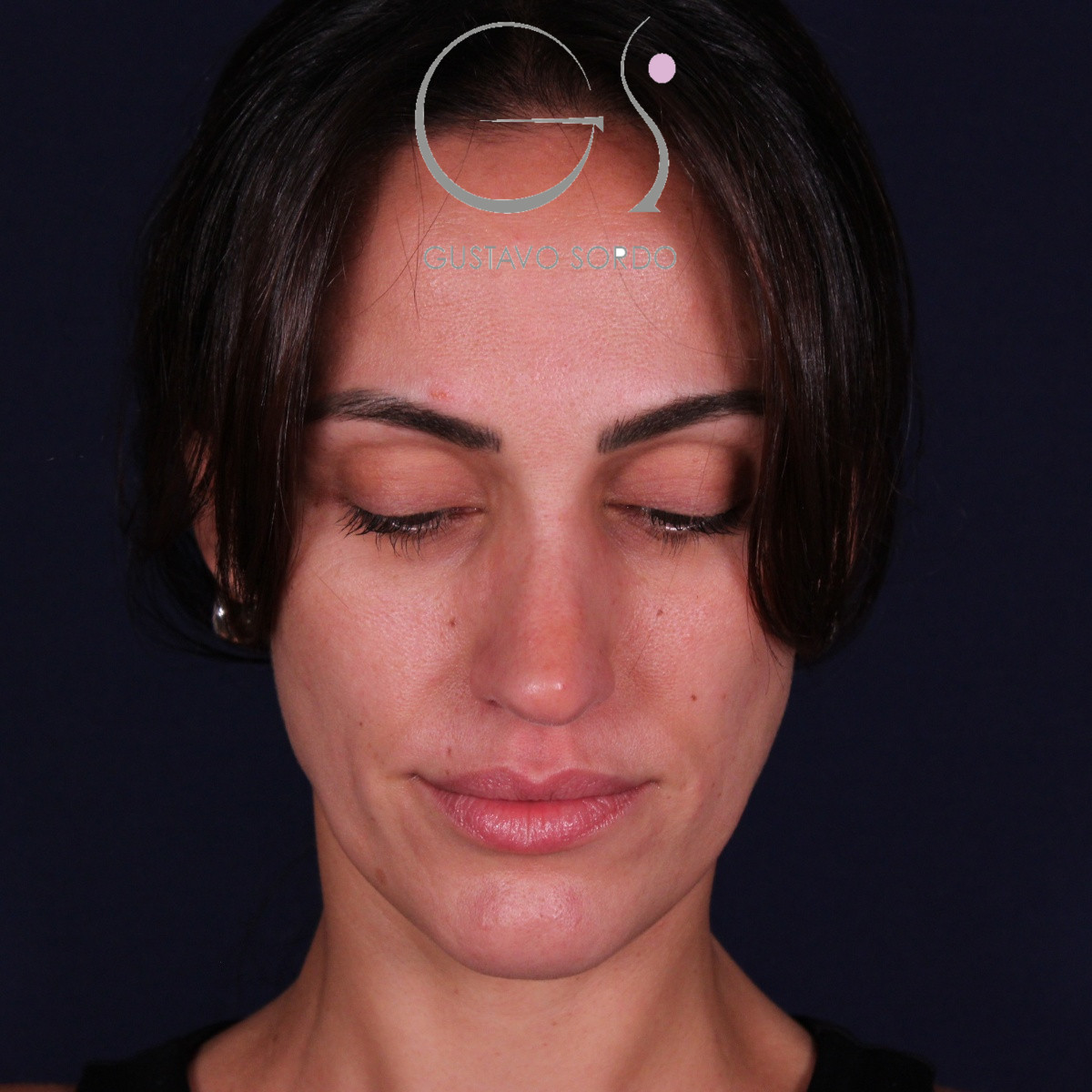 Rinoplastia ultrasónica en mujer con nariz aguileña y larga, punta caída y piel gruesa, después de la operación (2)