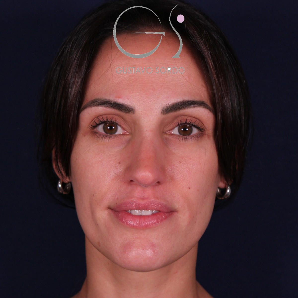 Rinoplastia ultrasónica en mujer con nariz aguileña y larga, punta caída y piel gruesa, después de la operación (1)