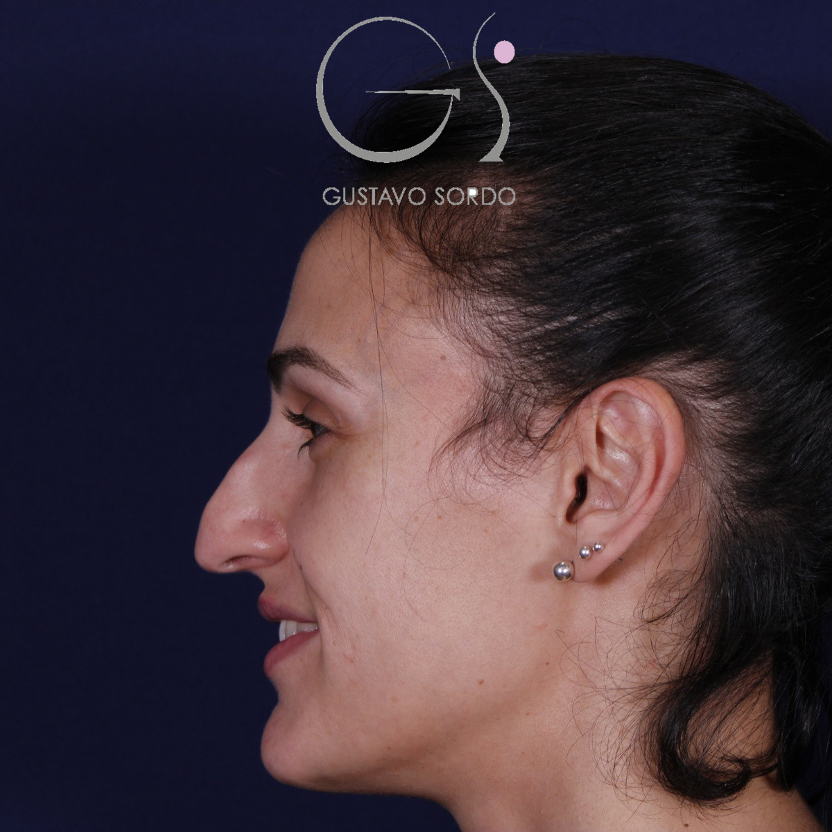 Rinoplastia ultrasónica en mujer con nariz aguileña y larga, punta caída y piel gruesa, antes de la operación (5)