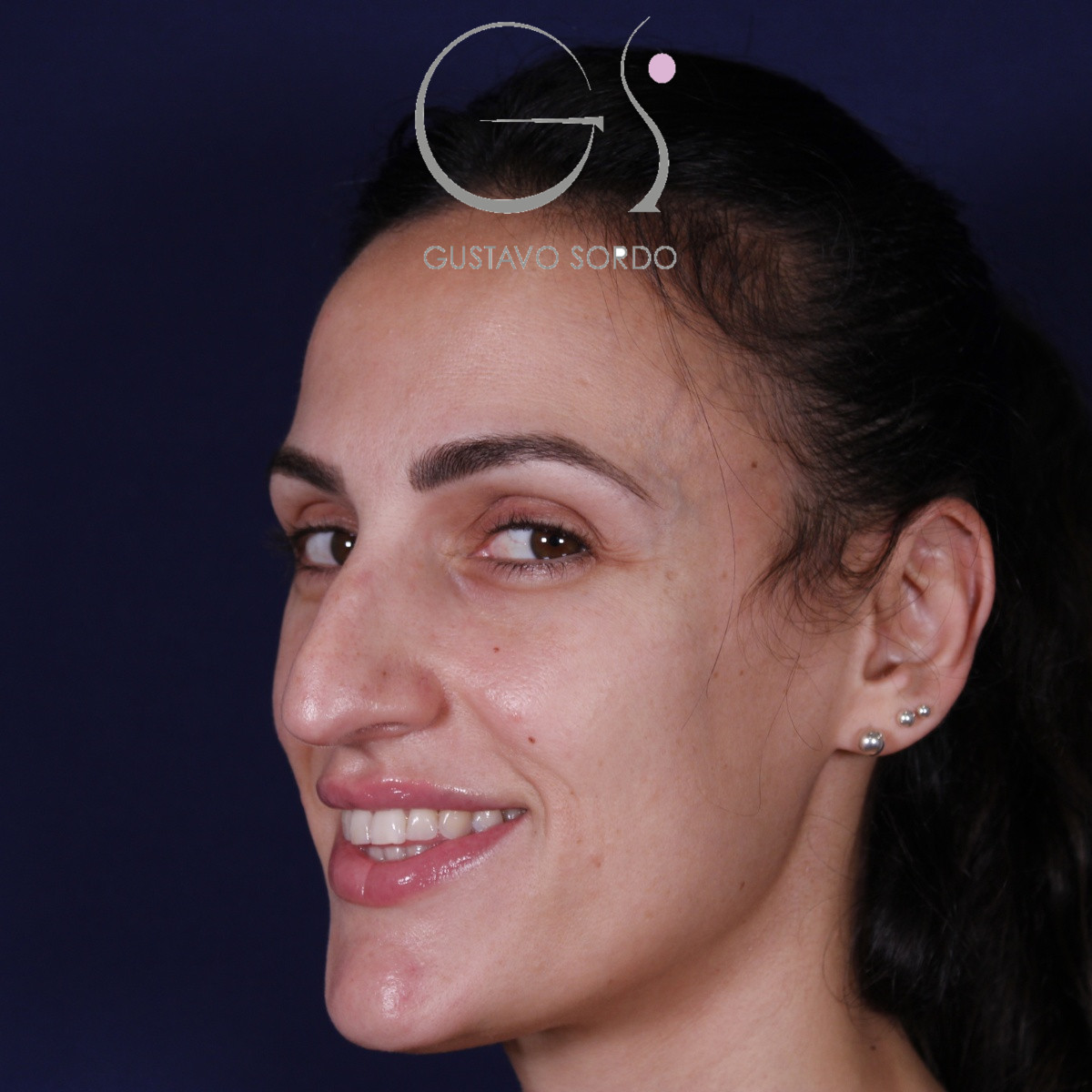 Rinoplastia ultrasónica en mujer con nariz aguileña y larga, punta caída y piel gruesa, antes de la operación (7)