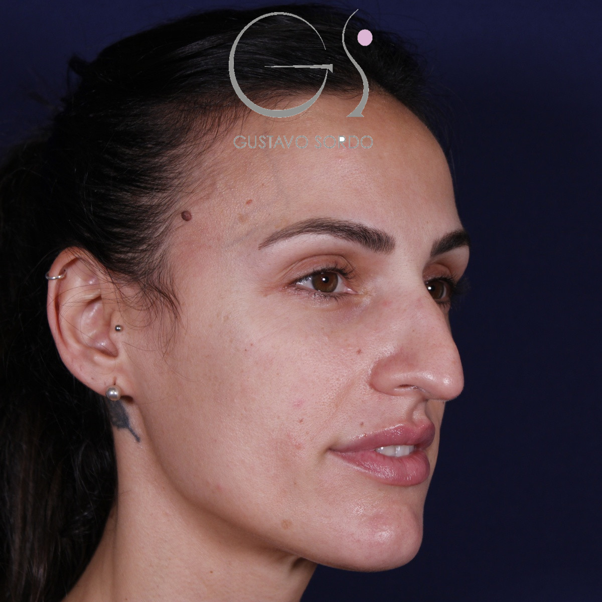 Rinoplastia ultrasónica en mujer con nariz aguileña y larga, punta caída y piel gruesa, antes de la operación (6)