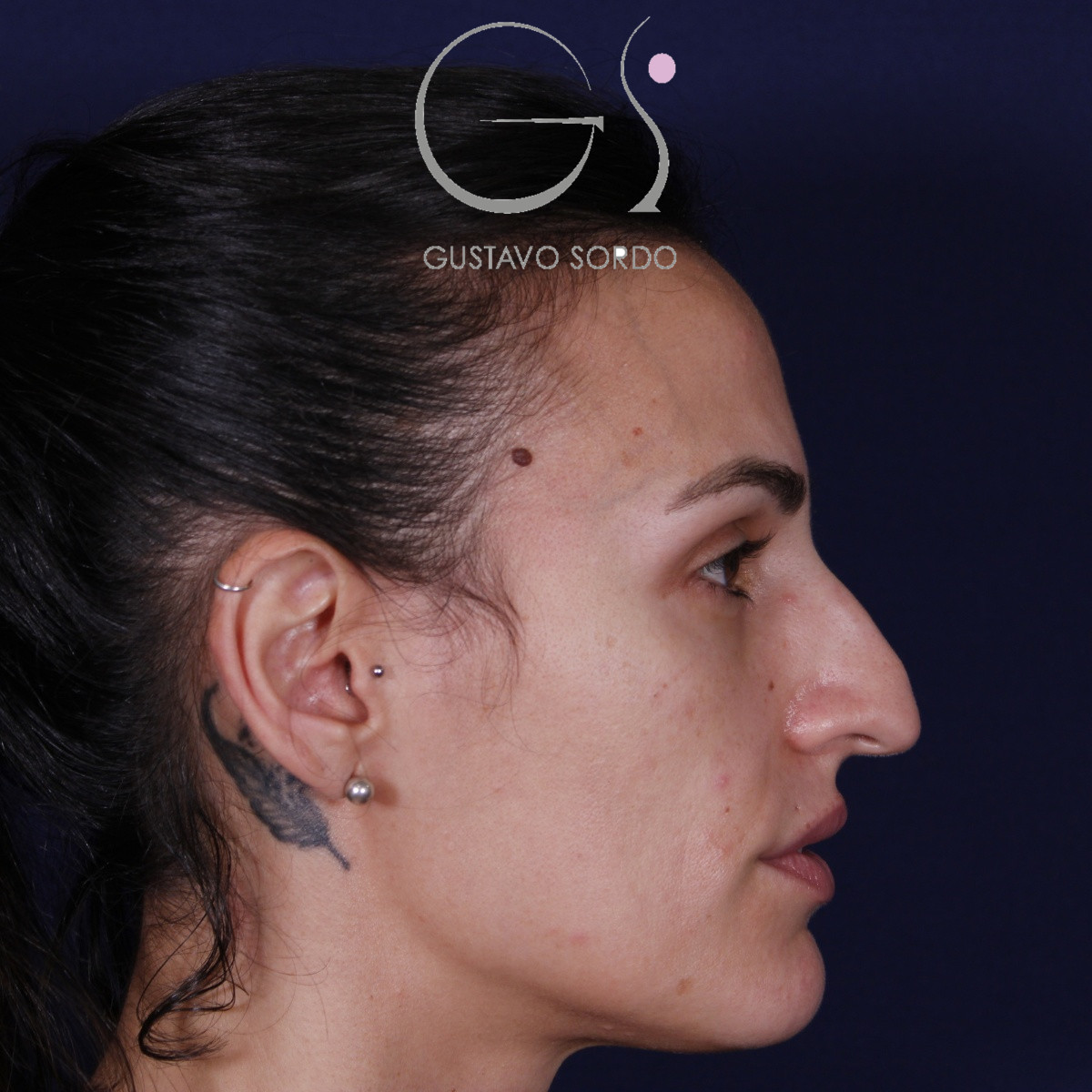 Rinoplastia ultrasónica en mujer con nariz aguileña y larga, punta caída y piel gruesa, antes de la operación (4)