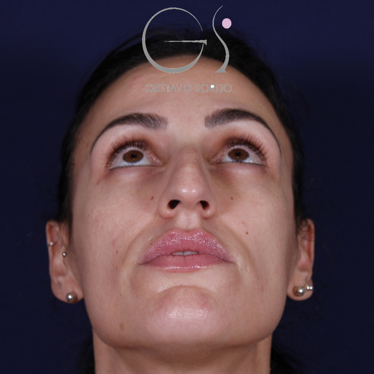 Rinoplastia ultrasónica en mujer con nariz aguileña y larga, punta caída y piel gruesa, antes de la operación (3)