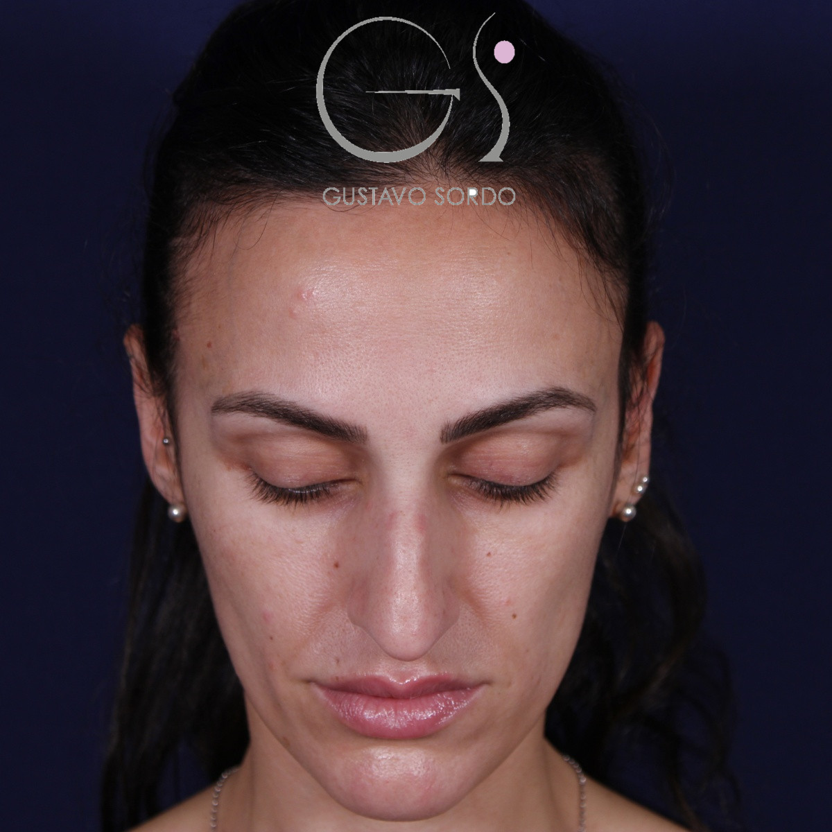 Rinoplastia ultrasónica en mujer con nariz aguileña y larga, punta caída y piel gruesa, antes de la operación (2)