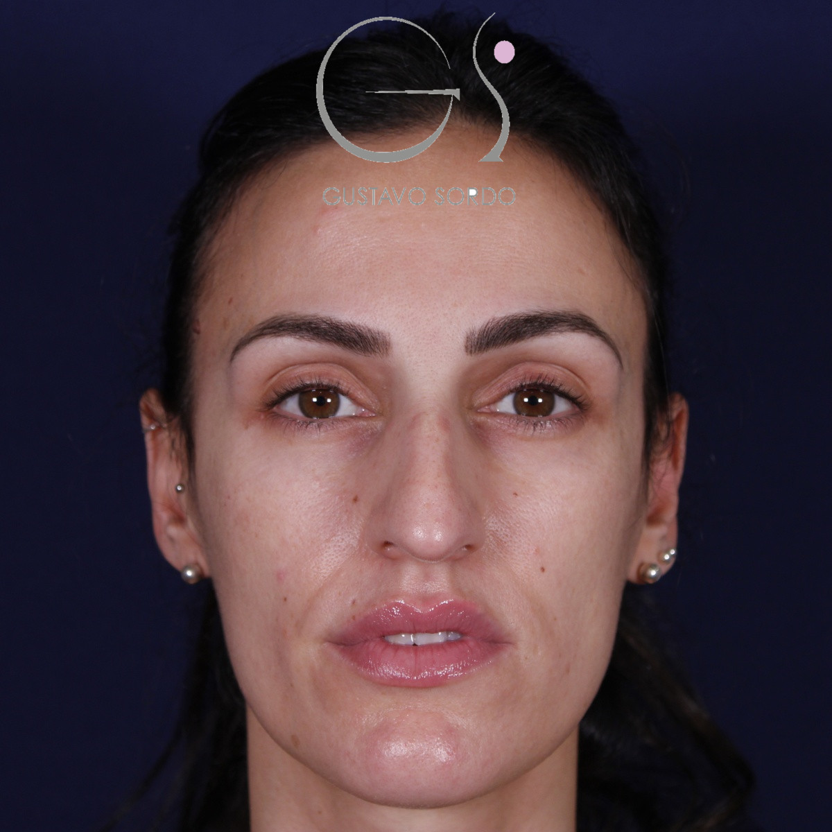 Rinoplastia ultrasónica en mujer con nariz aguileña y larga, punta caída y piel gruesa, antes de la operación (1)