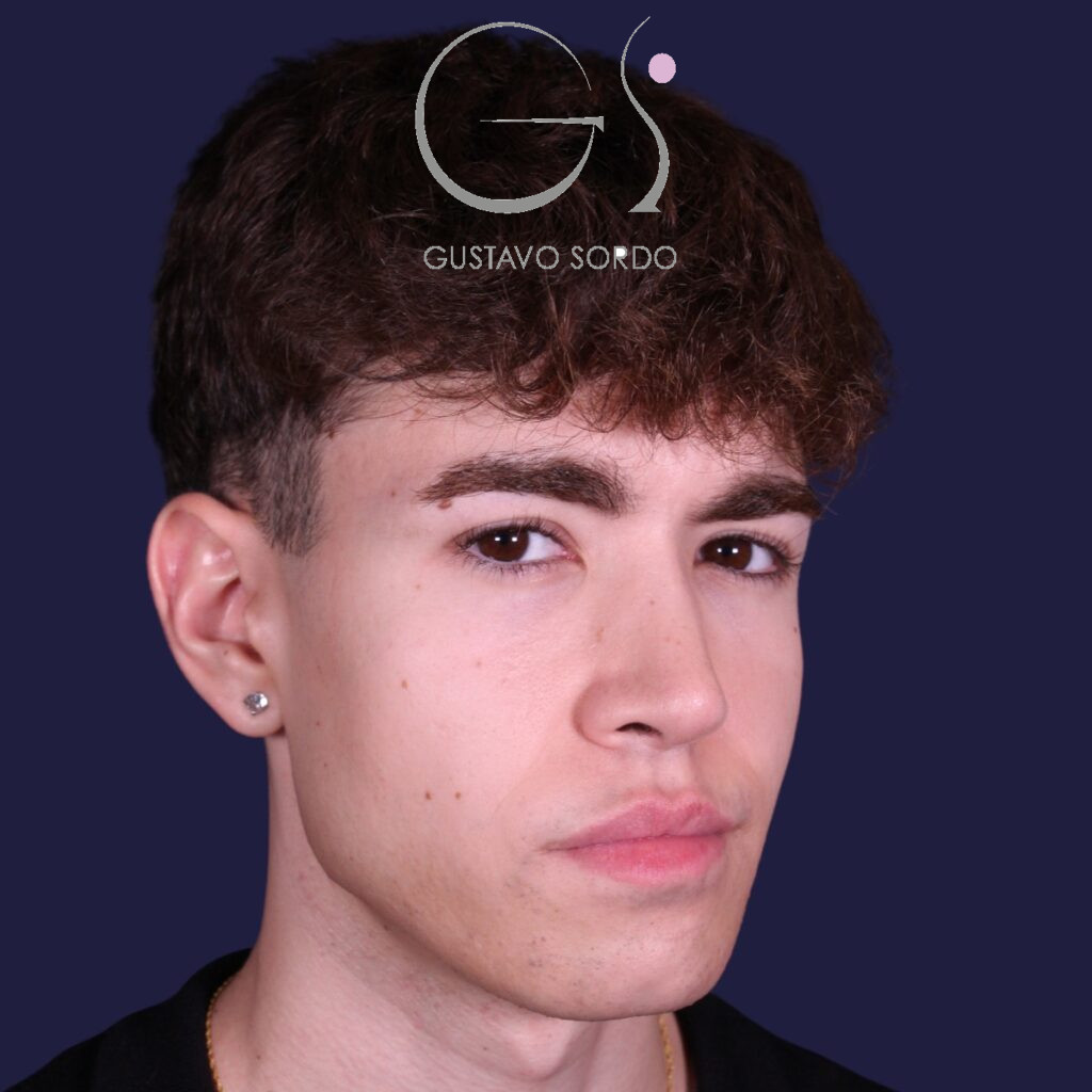 Rinoplastia ultrasónica en hombre con punta bulbosa, después de la operación (5)