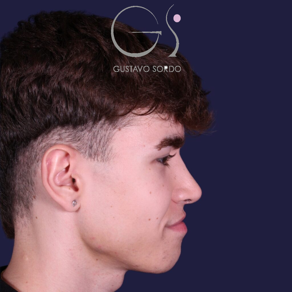 Rinoplastia ultrasónica en hombre con punta bulbosa, después de la operación (4)
