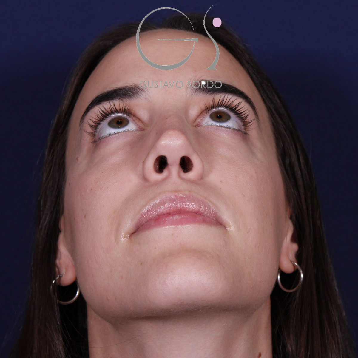 Rinoplastia ultrasónica en mujer con tabique desviado, después de la operación (2)