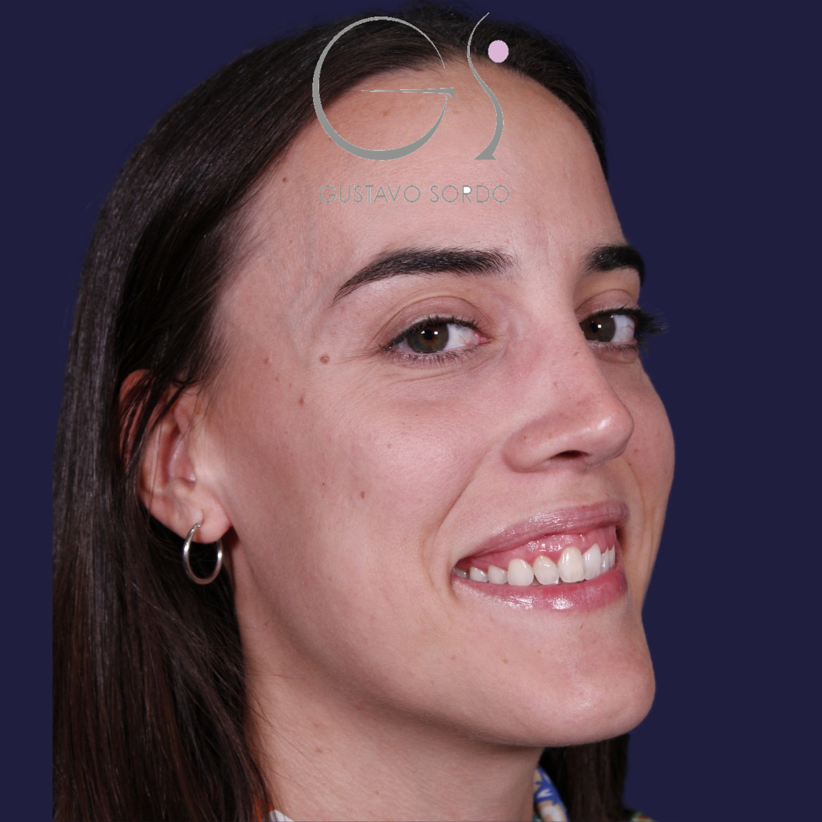 Rinoplastia ultrasónica en mujer con tabique desviado, después de la operación (7)