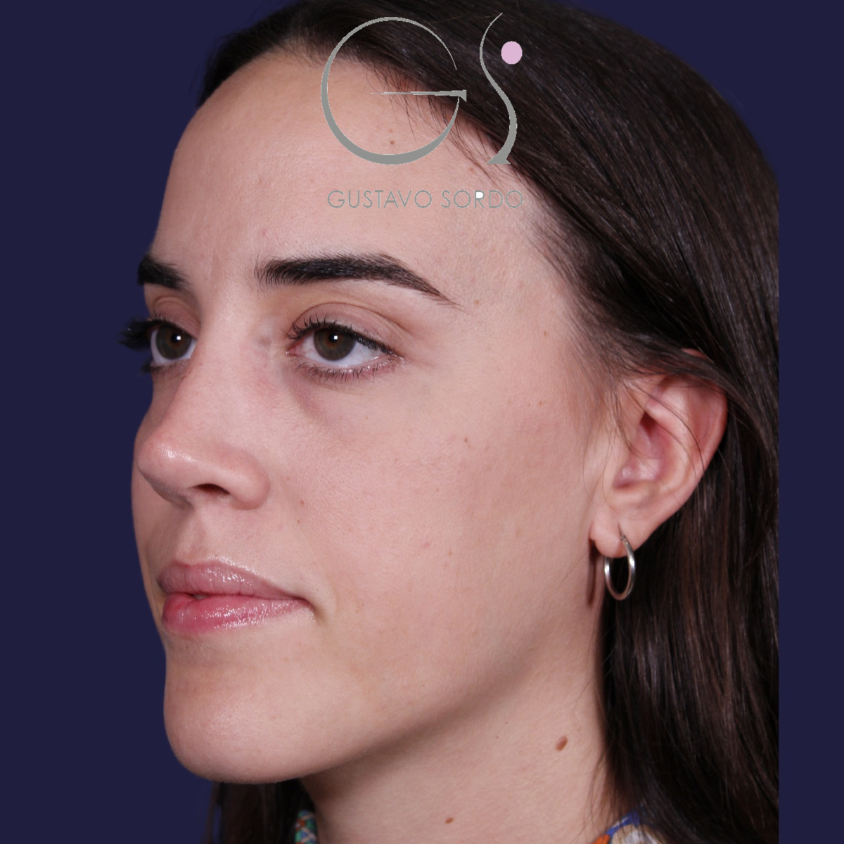 Rinoplastia ultrasónica en mujer con tabique desviado, después de la operación (6)