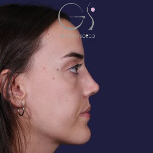 Rinoplastia en Madrid