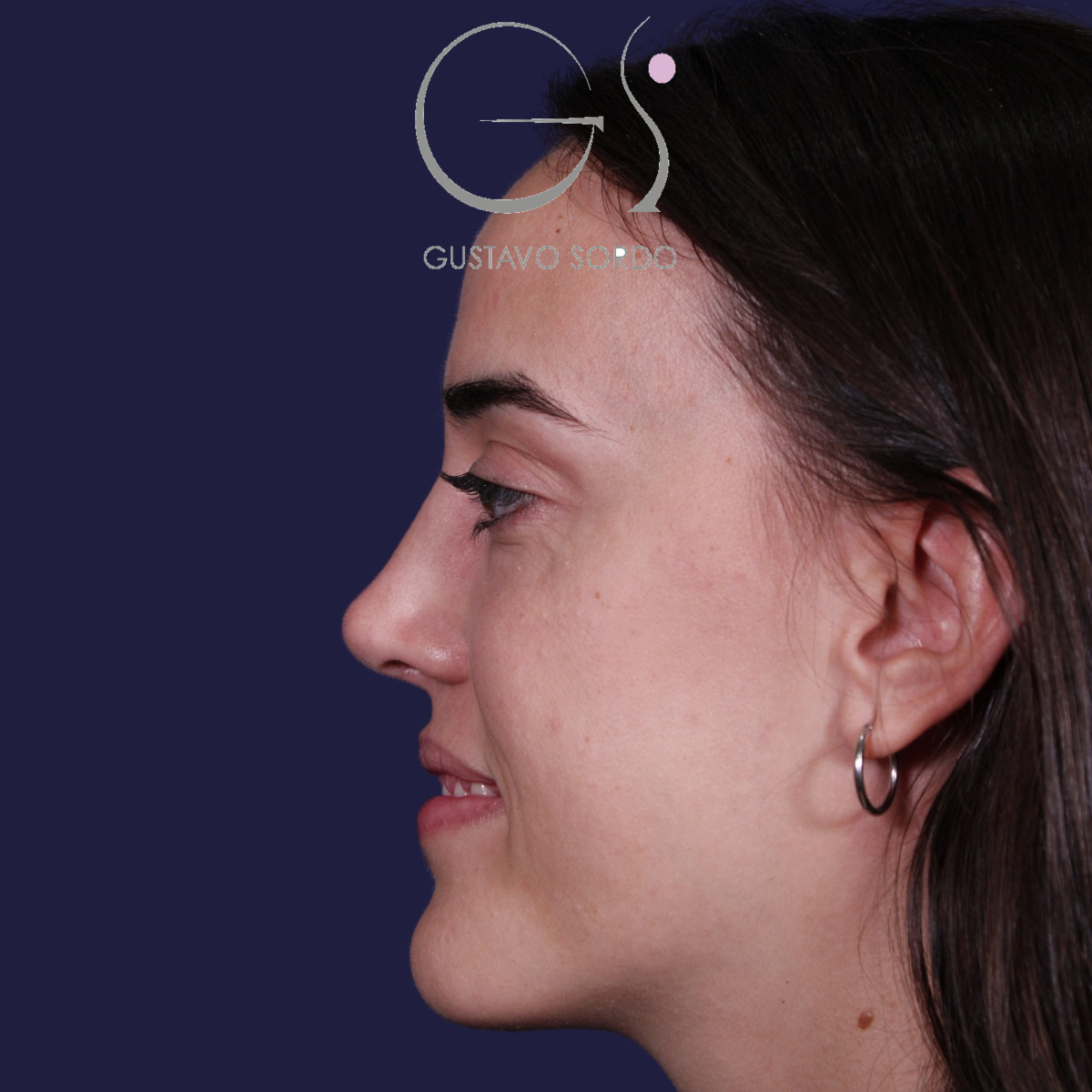 Rinoplastia ultrasónica en mujer con tabique desviado, después de la operación (5)