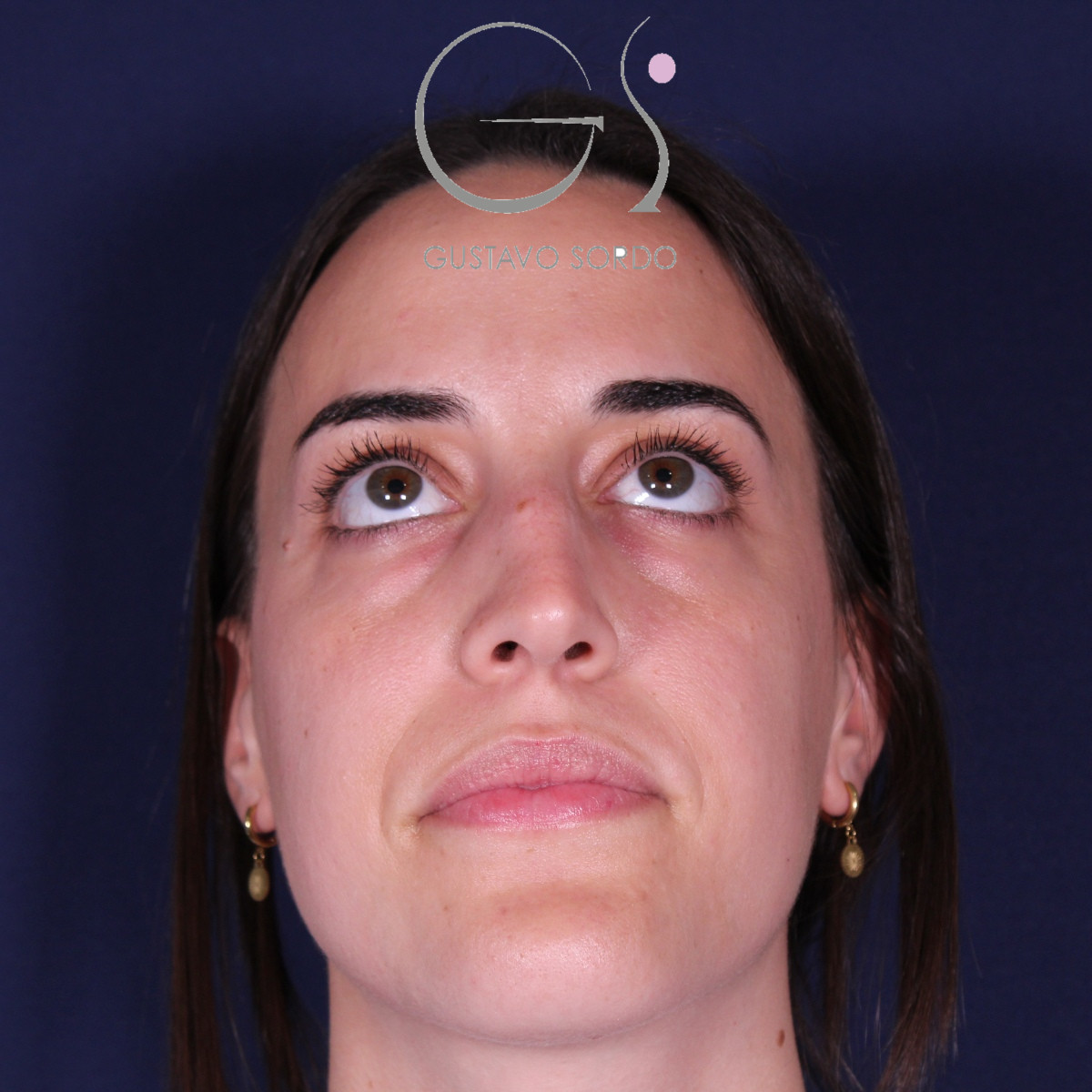 Rinoplastia ultrasónica en mujer con tabique desviado, antes de la operación (2)