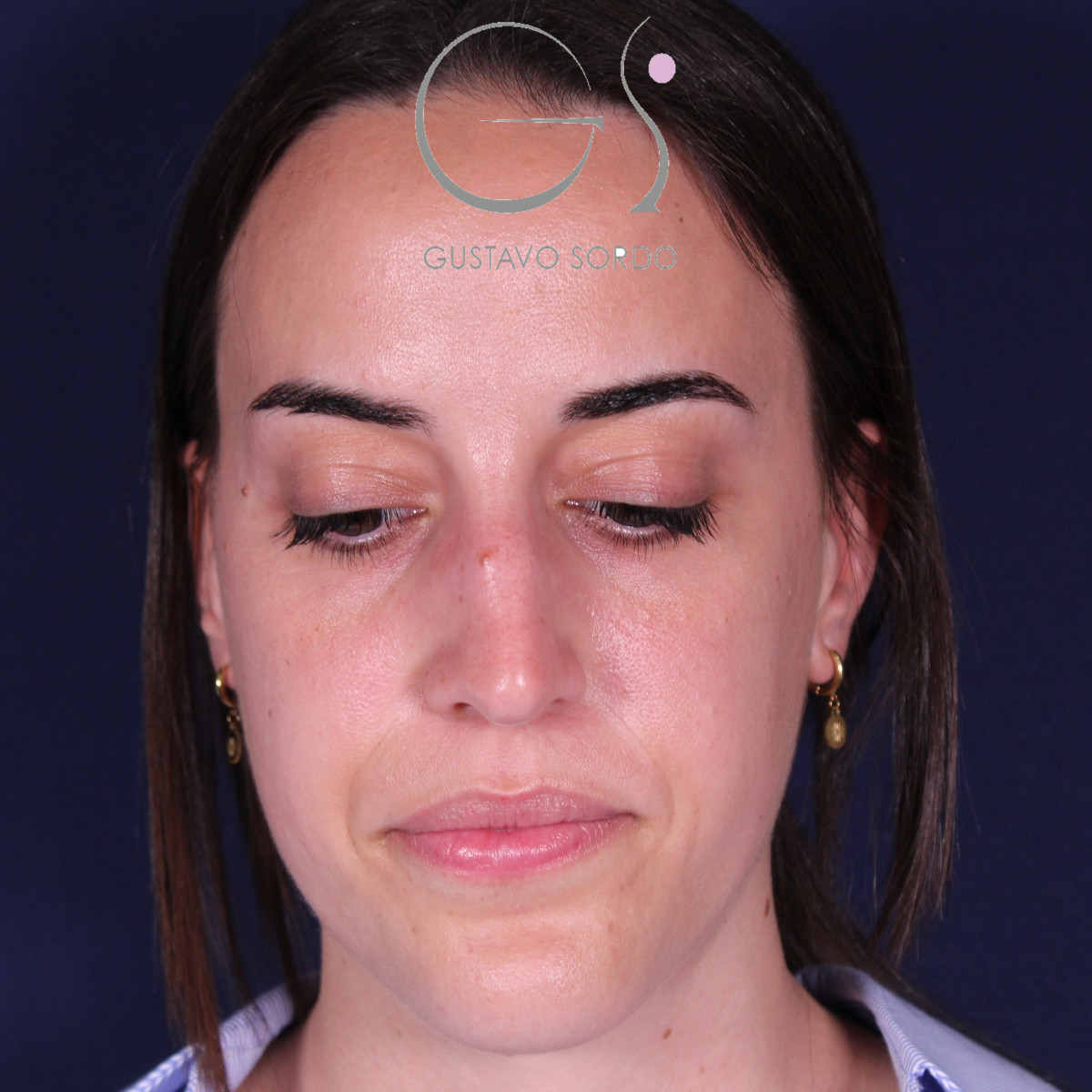 Rinoplastia ultrasónica en mujer con tabique desviado, antes de la operación (3)