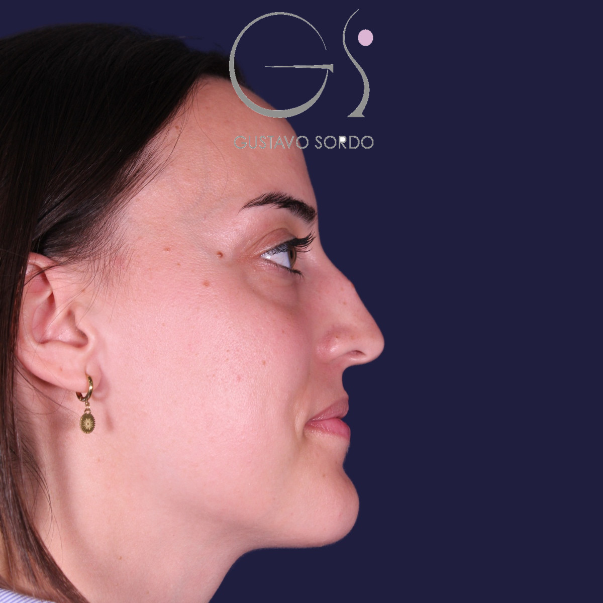 Rinoplastia ultrasónica en mujer con tabique desviado, antes de la operación (4)