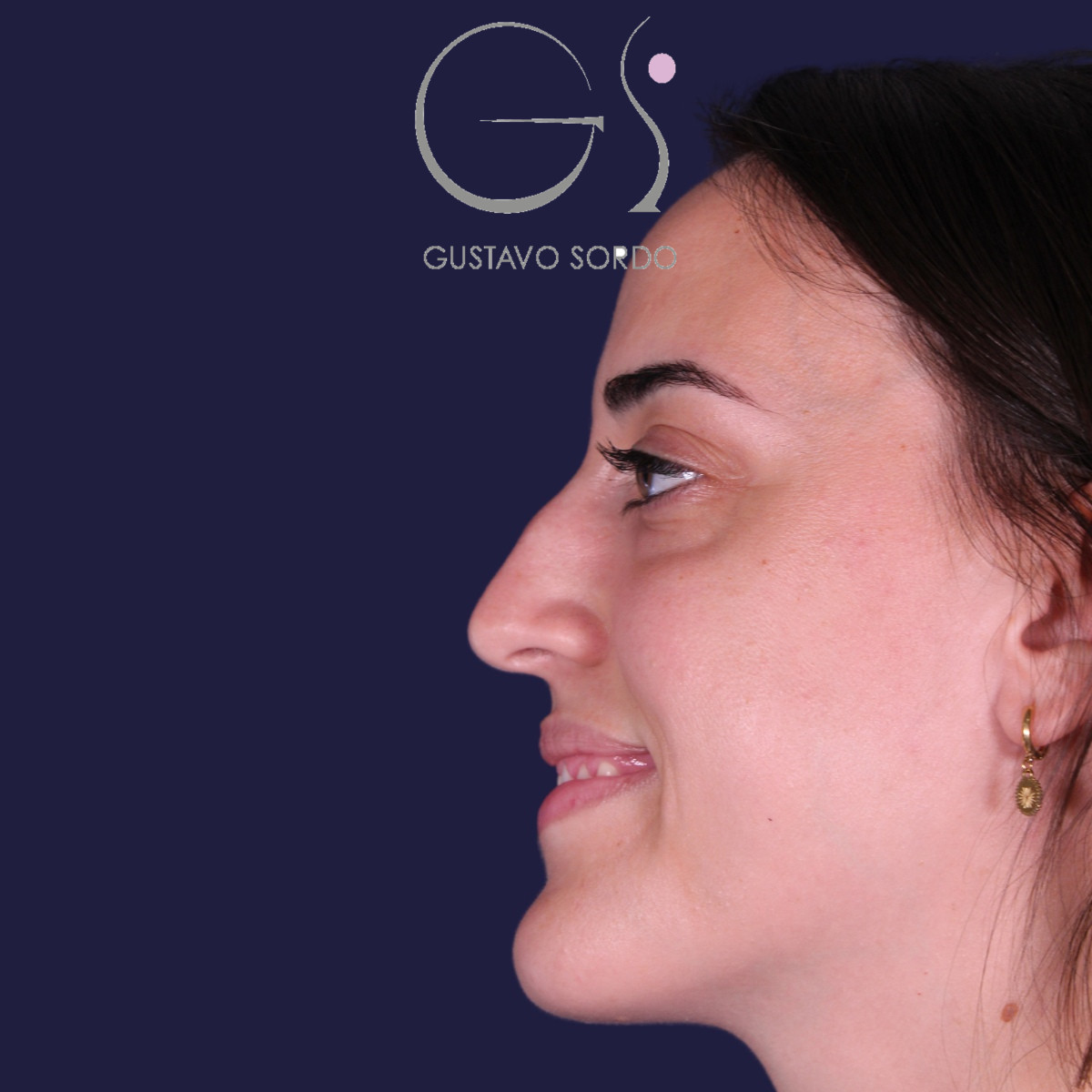 Rinoplastia ultrasónica en mujer con tabique desviado, antes de la operación (5)