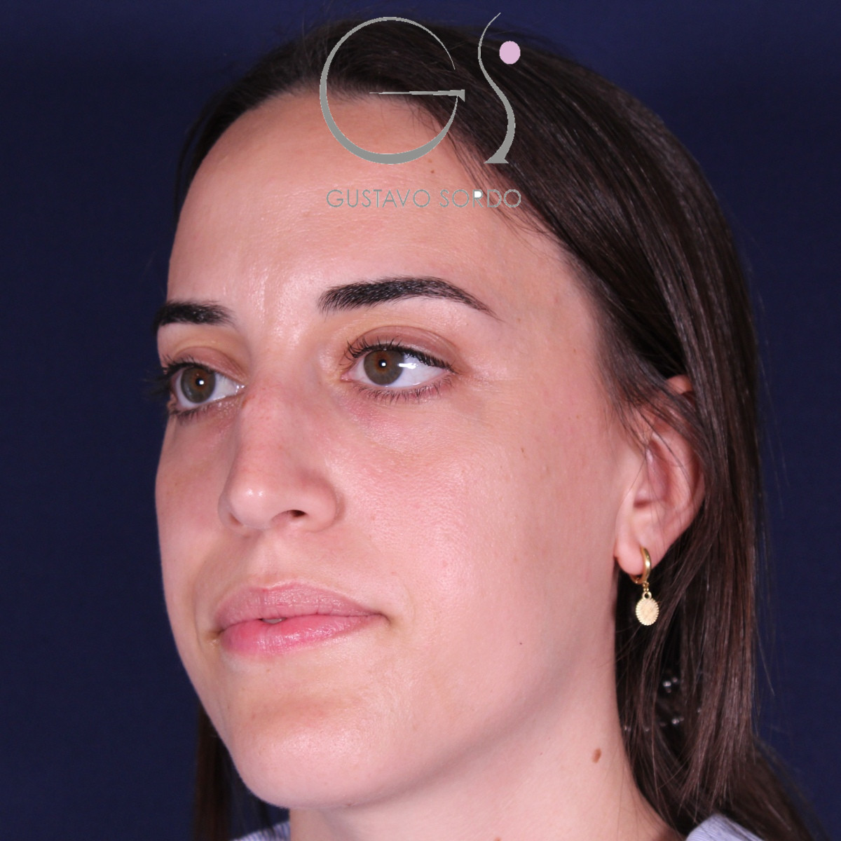 Rinoplastia ultrasónica en mujer con tabique desviado, antes de la operación (6)