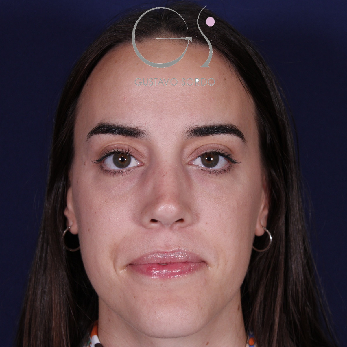 Rinoplastia ultrasónica en mujer con tabique desviado, después de la operación (1)