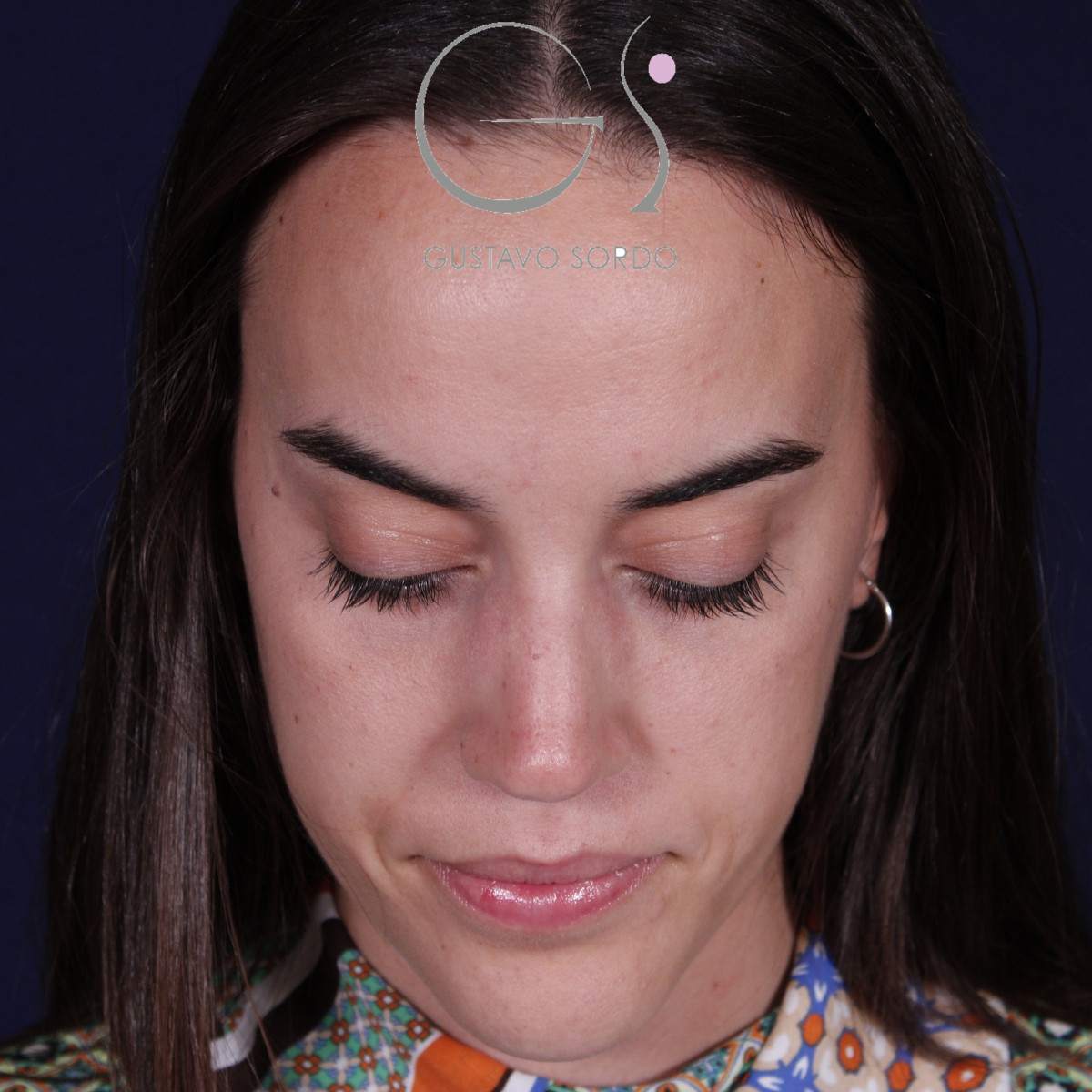 Rinoplastia ultrasónica en mujer con tabique desviado, después de la operación (3)