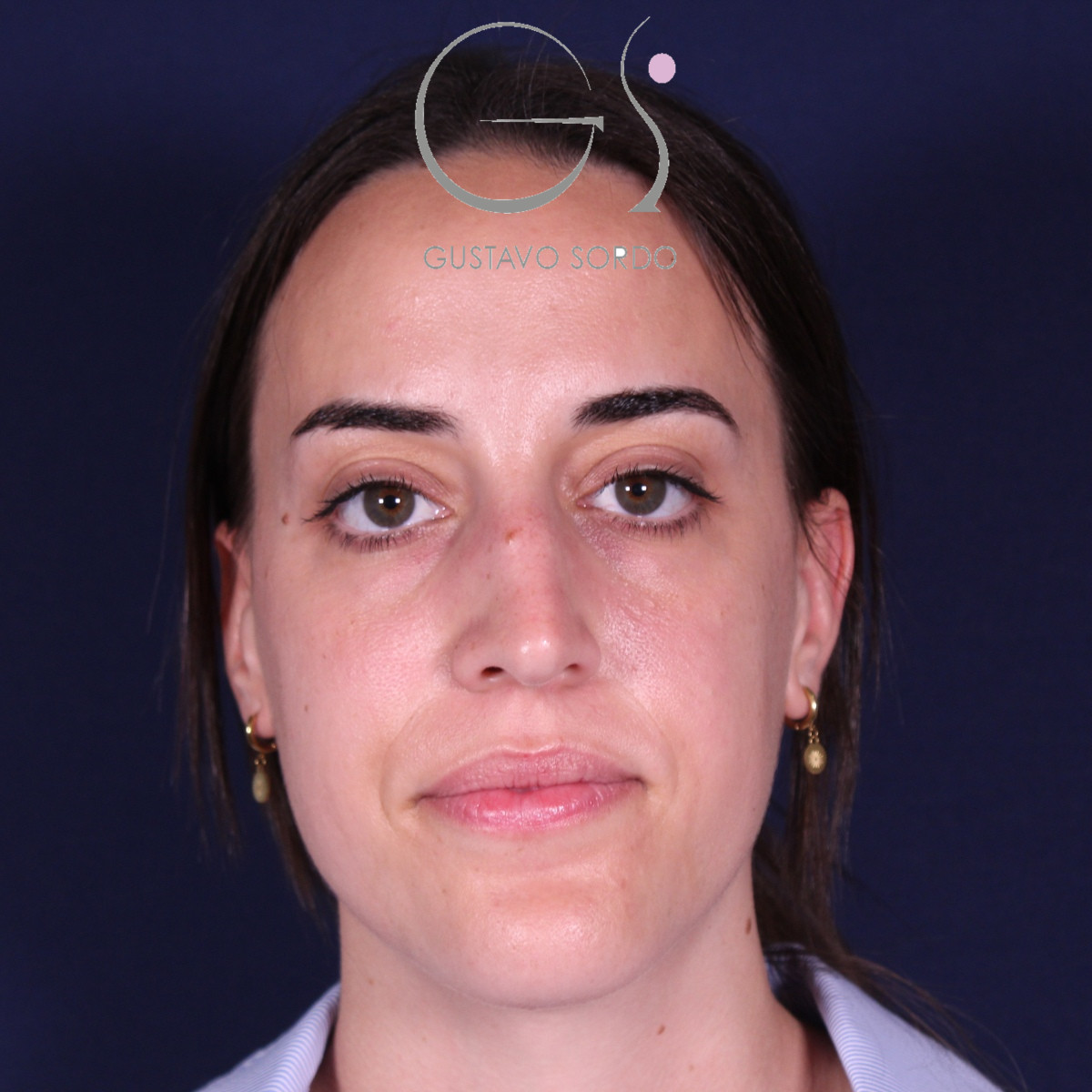 Rinoplastia ultrasónica en mujer con tabique desviado, antes de la operación (1)