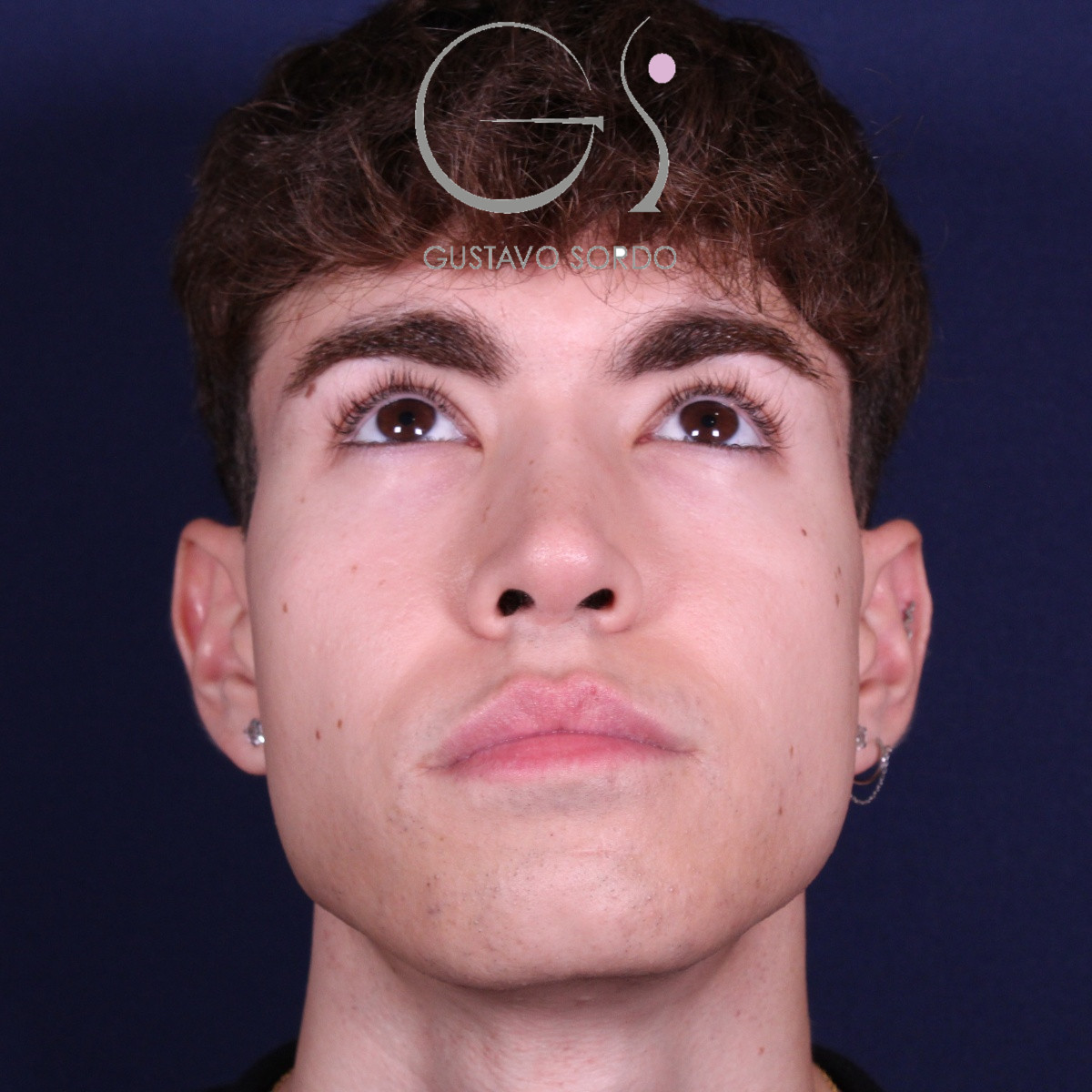 Rinoplastia ultrasónica en hombre con punta bulbosa, después de la operación (2)