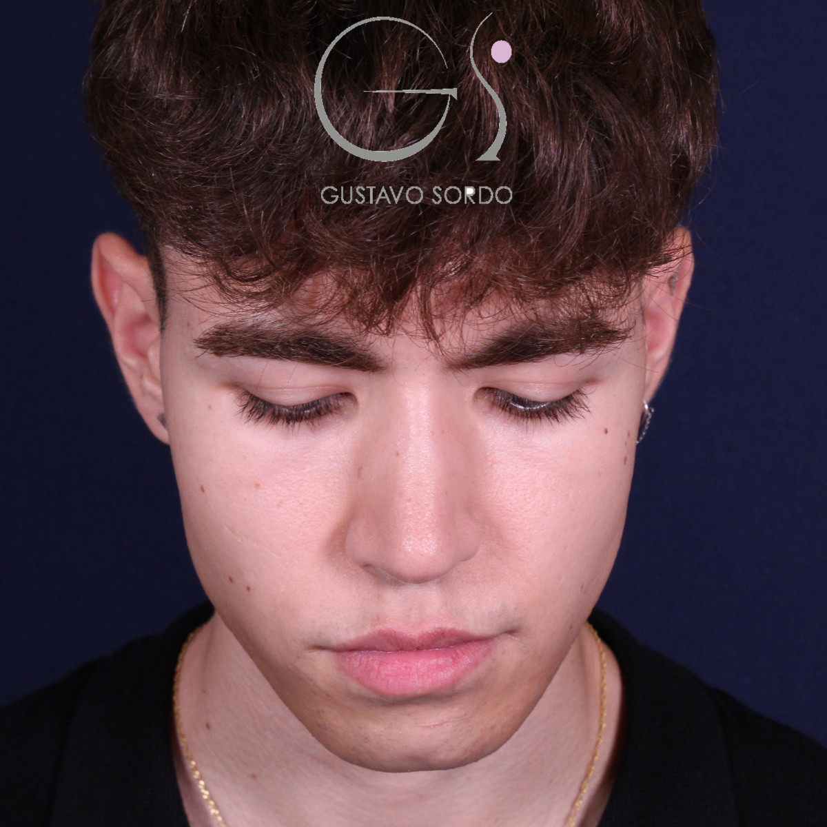 Rinoplastia ultrasónica en hombre con punta bulbosa, después de la operación (3)