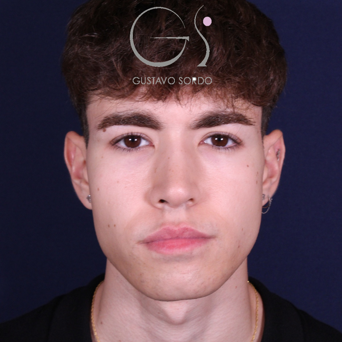 Rinoplastia ultrasónica en hombre con punta bulbosa, después de la operación (1)