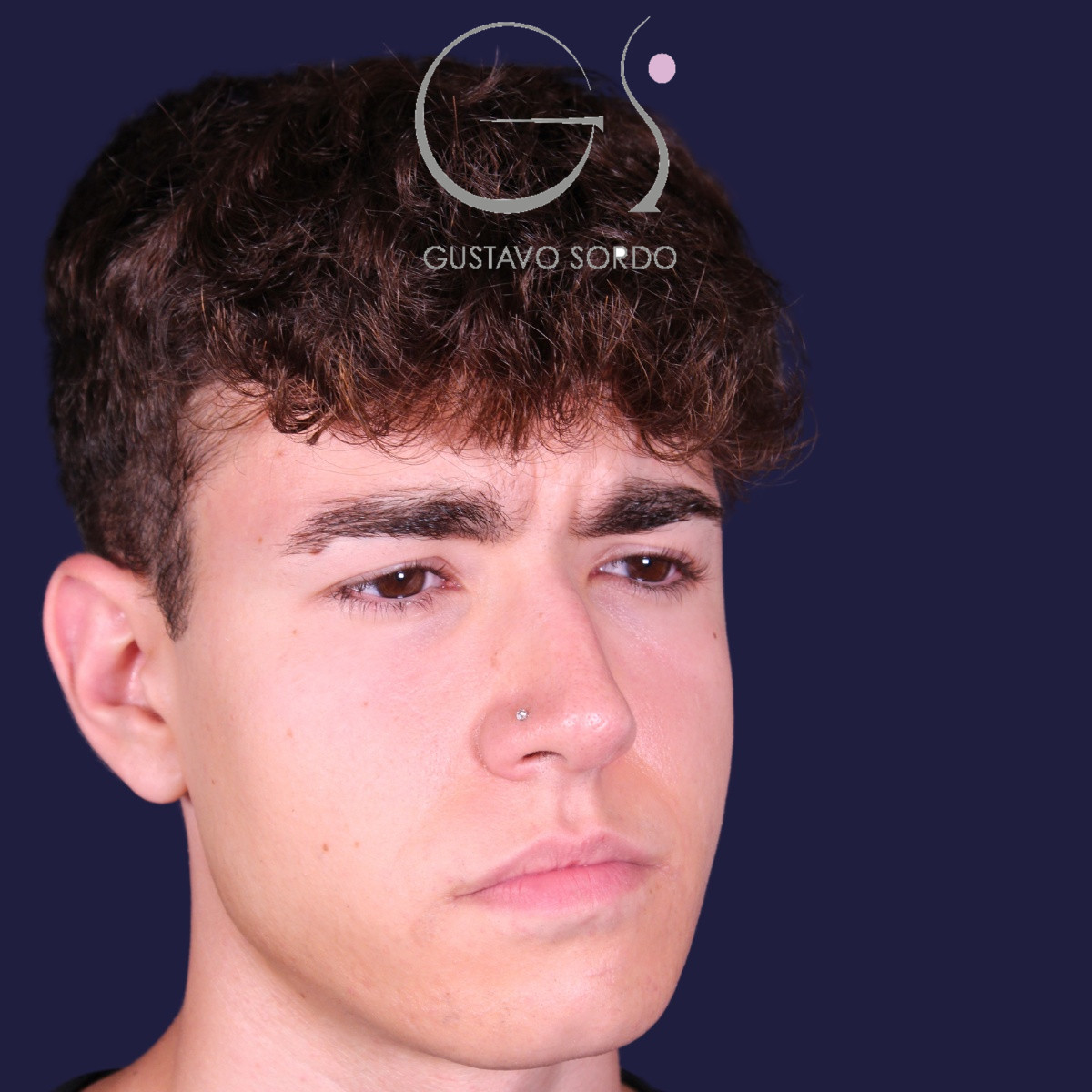 Rinoplastia ultrasónica en hombre con punta bulbosa, antes de la operación (5)