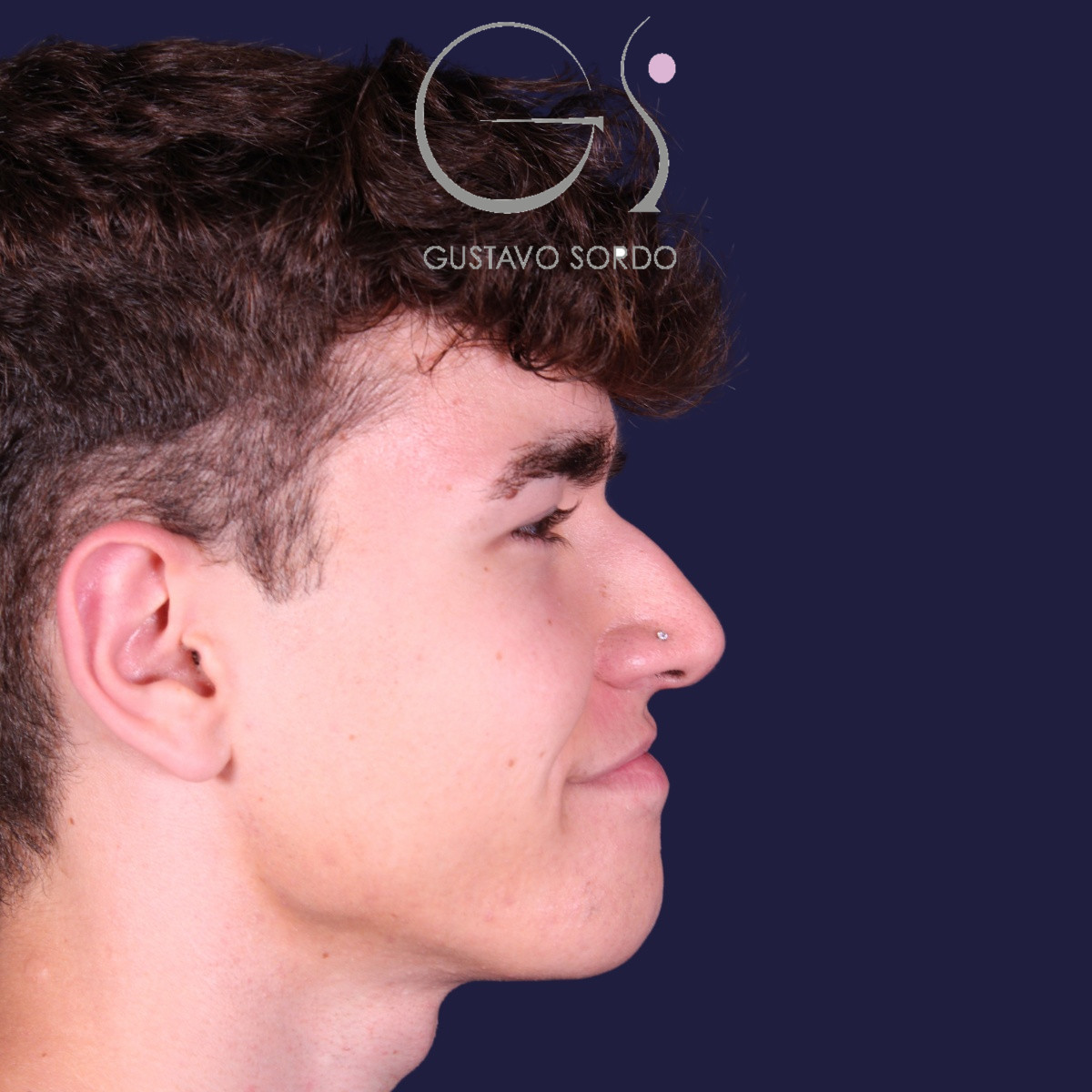 Rinoplastia ultrasónica en hombre con punta bulbosa, antes de la operación (4)