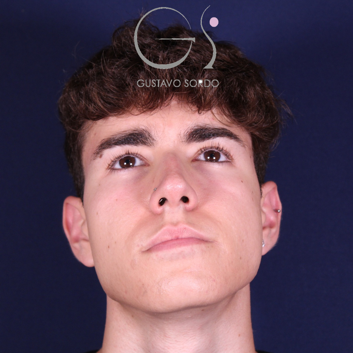 Rinoplastia ultrasónica en hombre con punta bulbosa, antes de la operación (2)