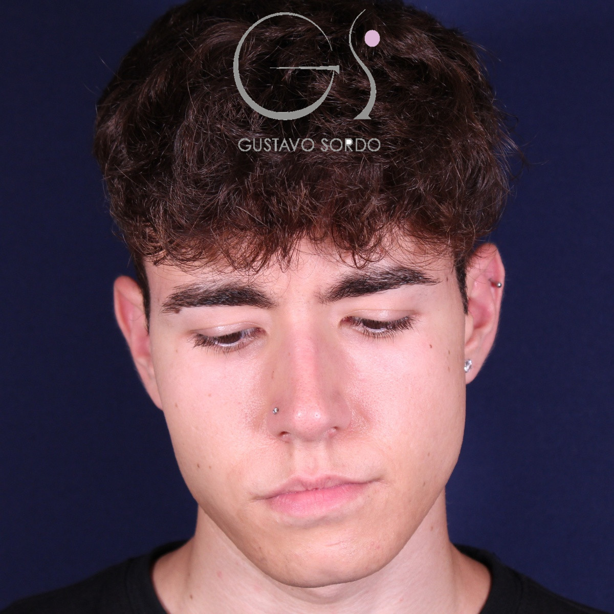 Rinoplastia ultrasónica en hombre con punta bulbosa, antes de la operación (3)