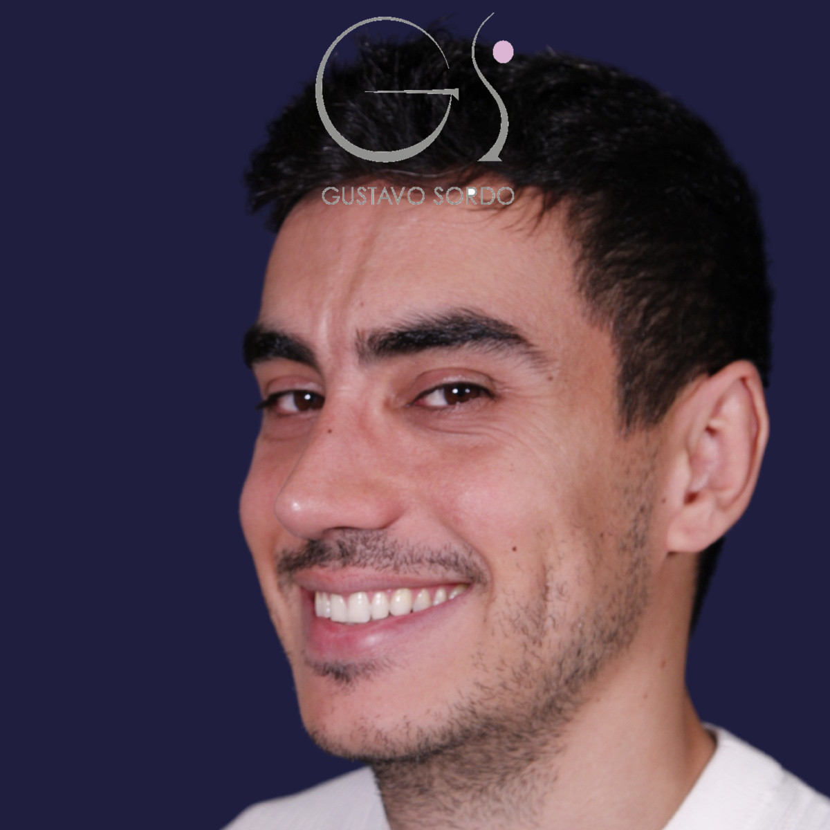 Rinoplastia ultrasónica en hombre con piel gruesa, después de la operación (7)
