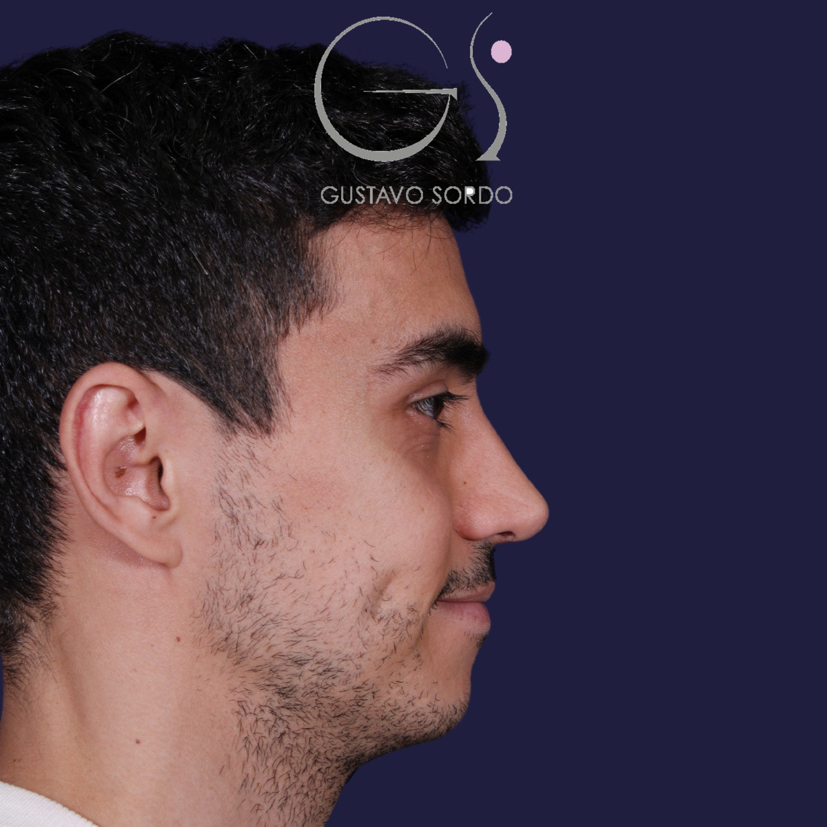 Rinoplastia ultrasónica en hombre con piel gruesa, después de la operación (6)