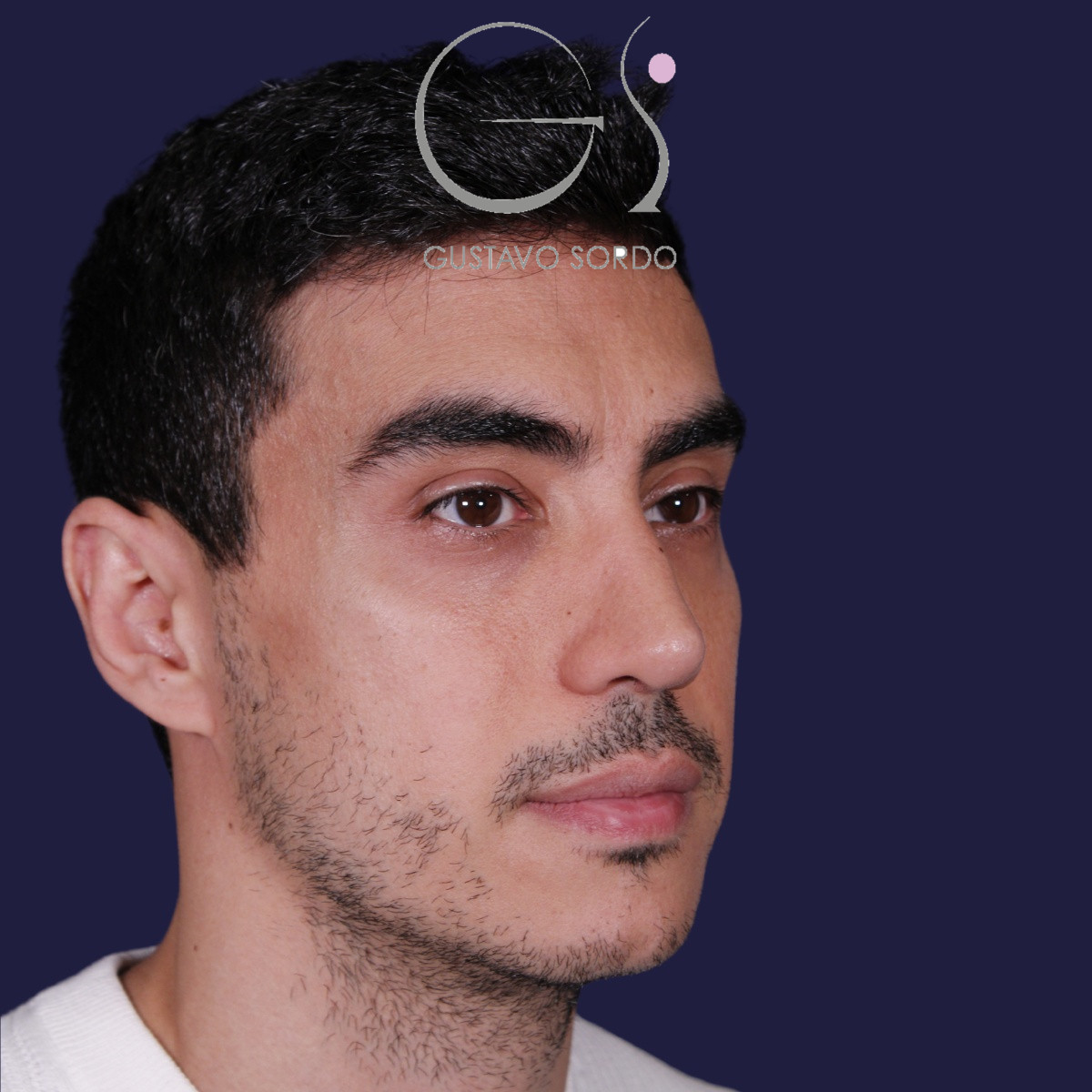 Rinoplastia ultrasónica en hombre con piel gruesa, después de la operación (5)