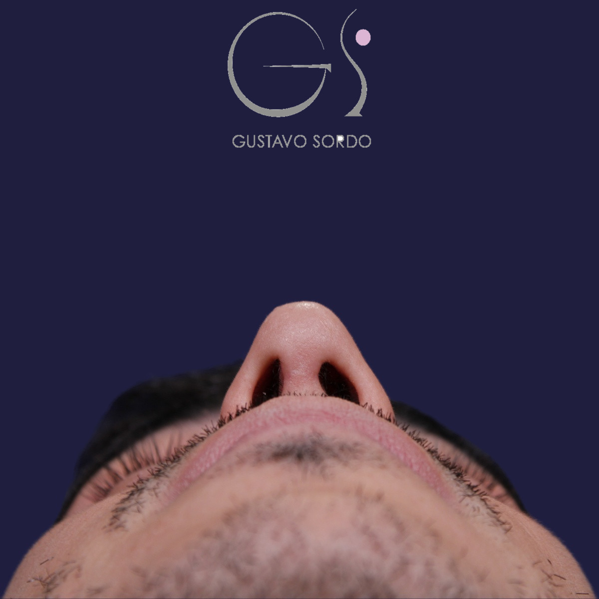 Rinoplastia ultrasónica en hombre con piel gruesa, después de la operación (4)