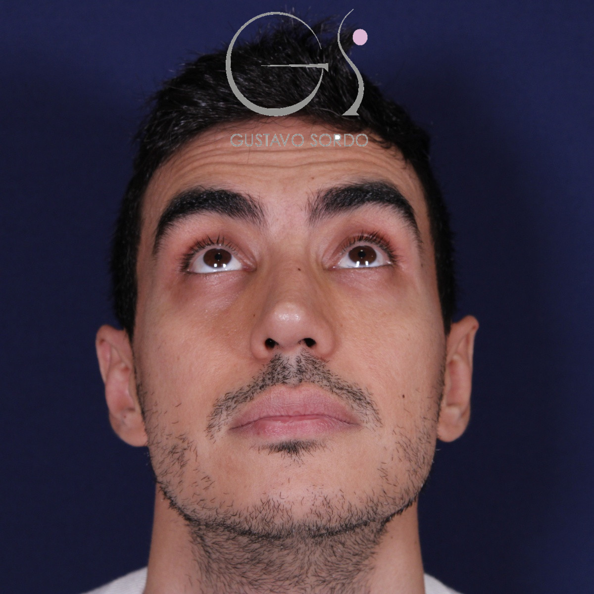 Rinoplastia ultrasónica en hombre con piel gruesa, después de la operación (3)