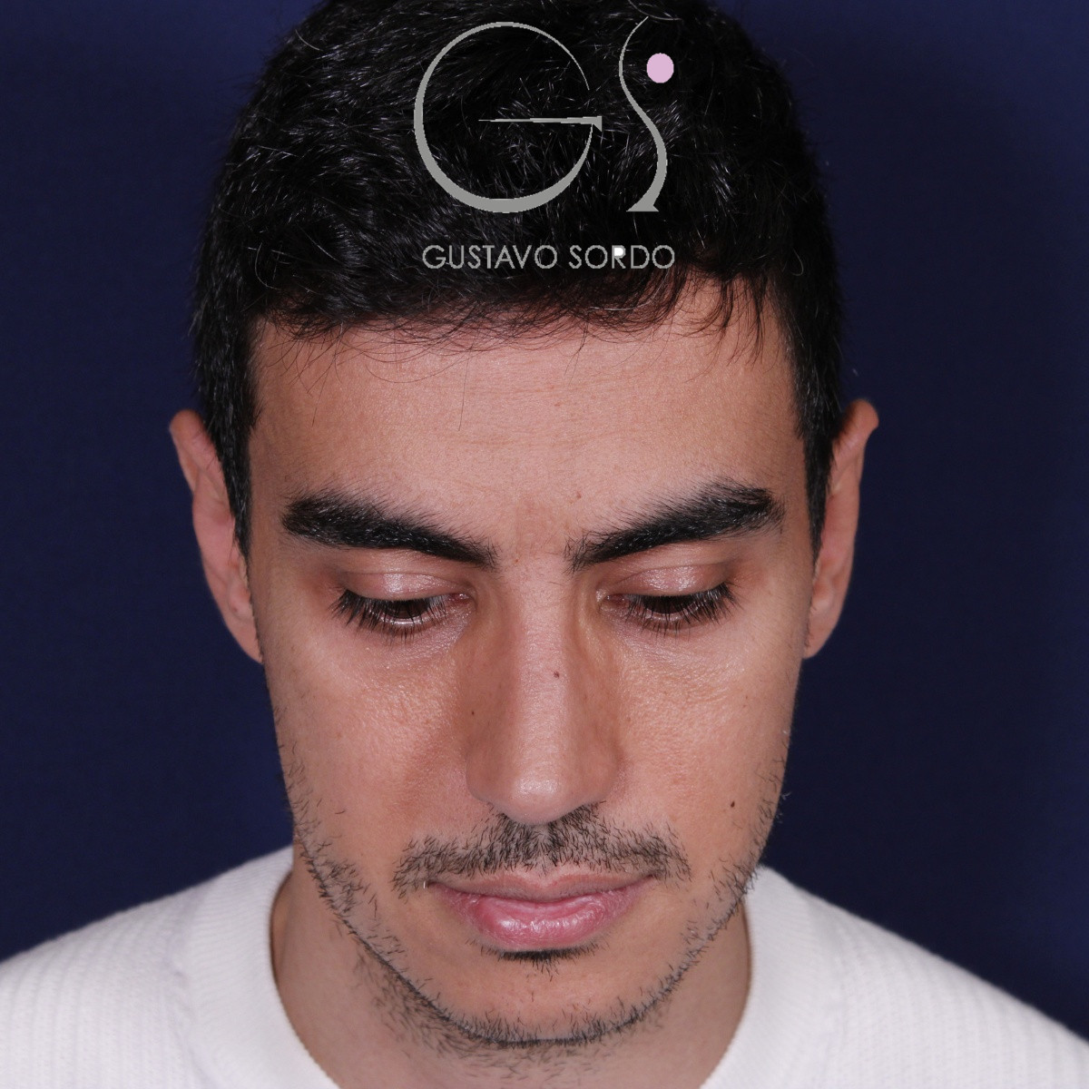Rinoplastia ultrasónica en hombre con piel gruesa, después de la operación (2)