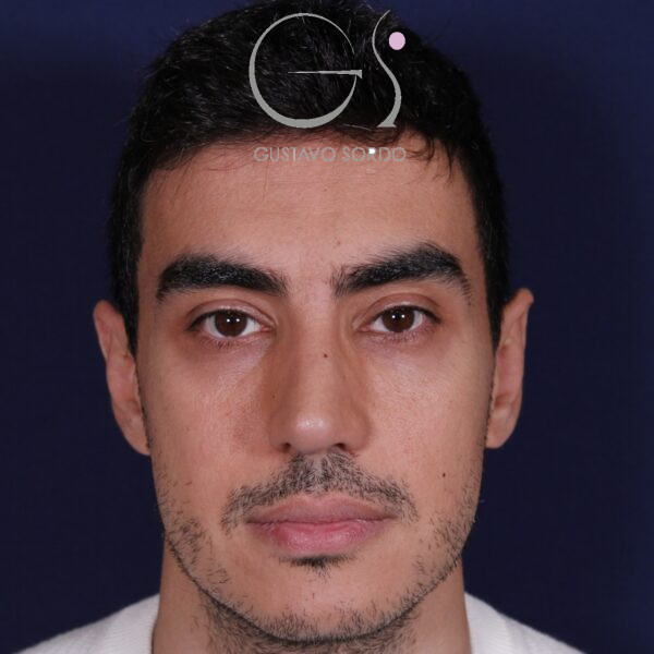 Rinoplastia ultrasónica en hombre con piel gruesa, después de la operación (1)