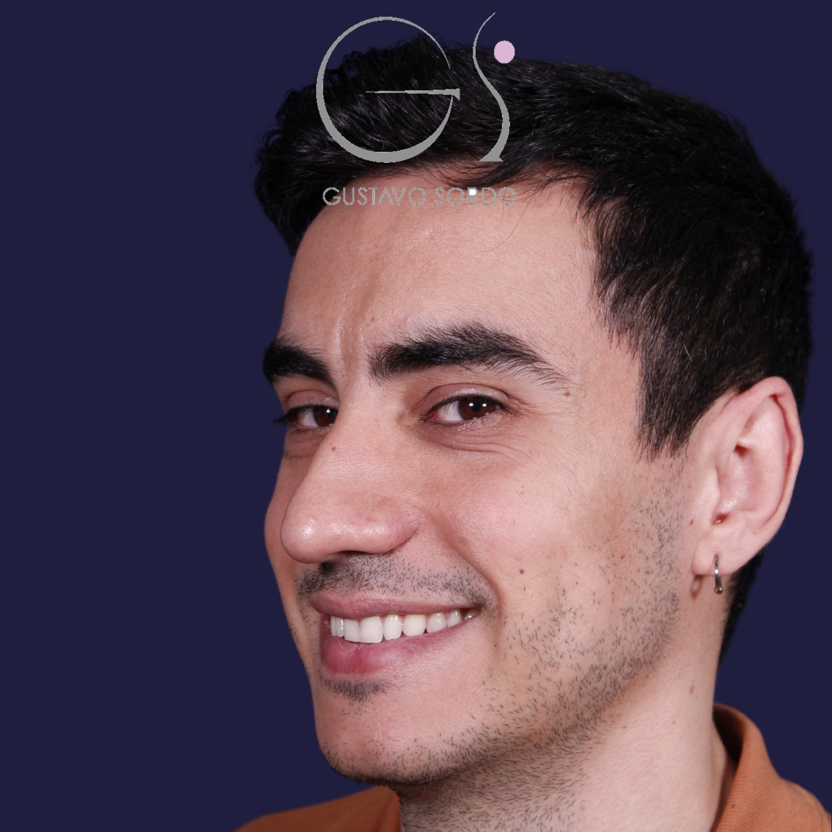 Rinoplastia ultrasónica en hombre con piel gruesa, antes de la operación (7)