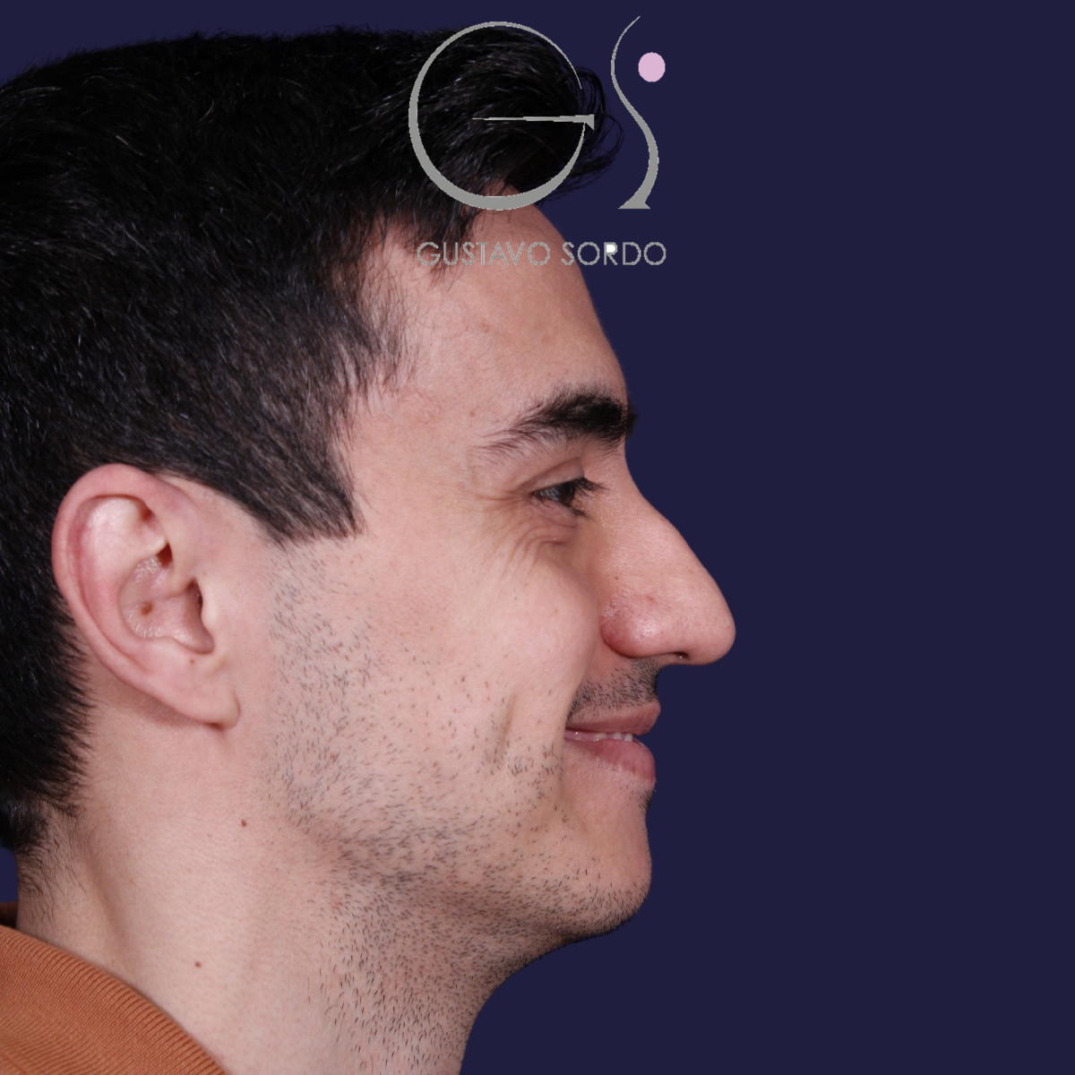 Rinoplastia ultrasónica en hombre con piel gruesa, antes de la operación (6)