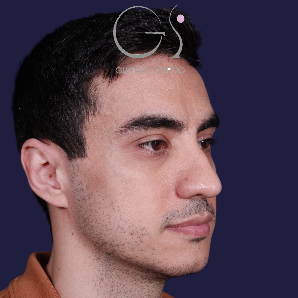 Rinoplastia ultrasónica en hombre con piel gruesa, antes de la operación (5)