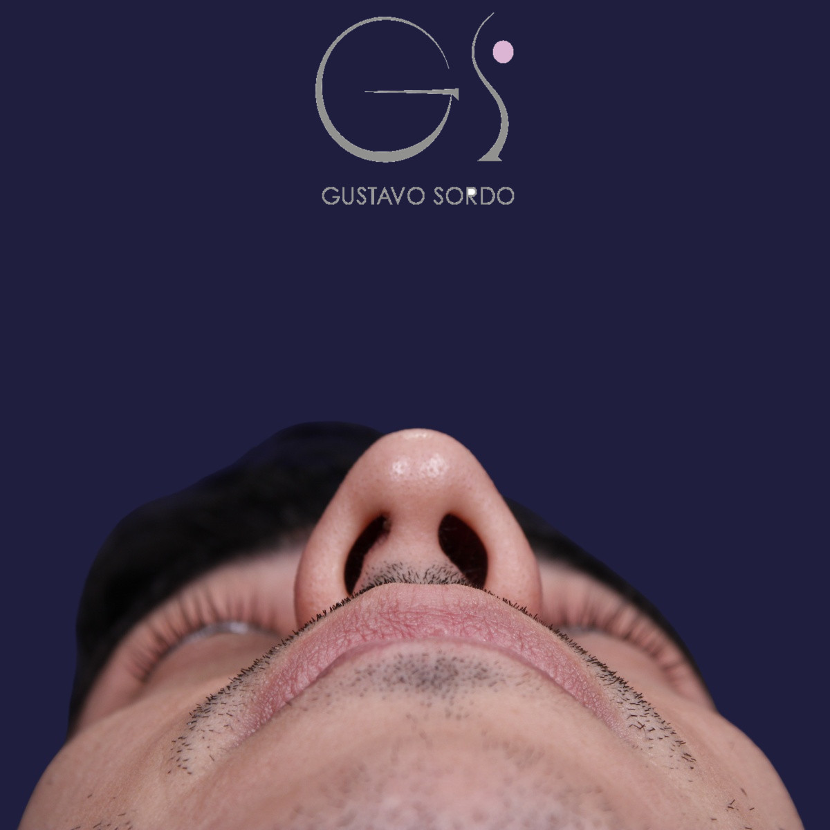 Rinoplastia ultrasónica en hombre con piel gruesa, antes de la operación (4)