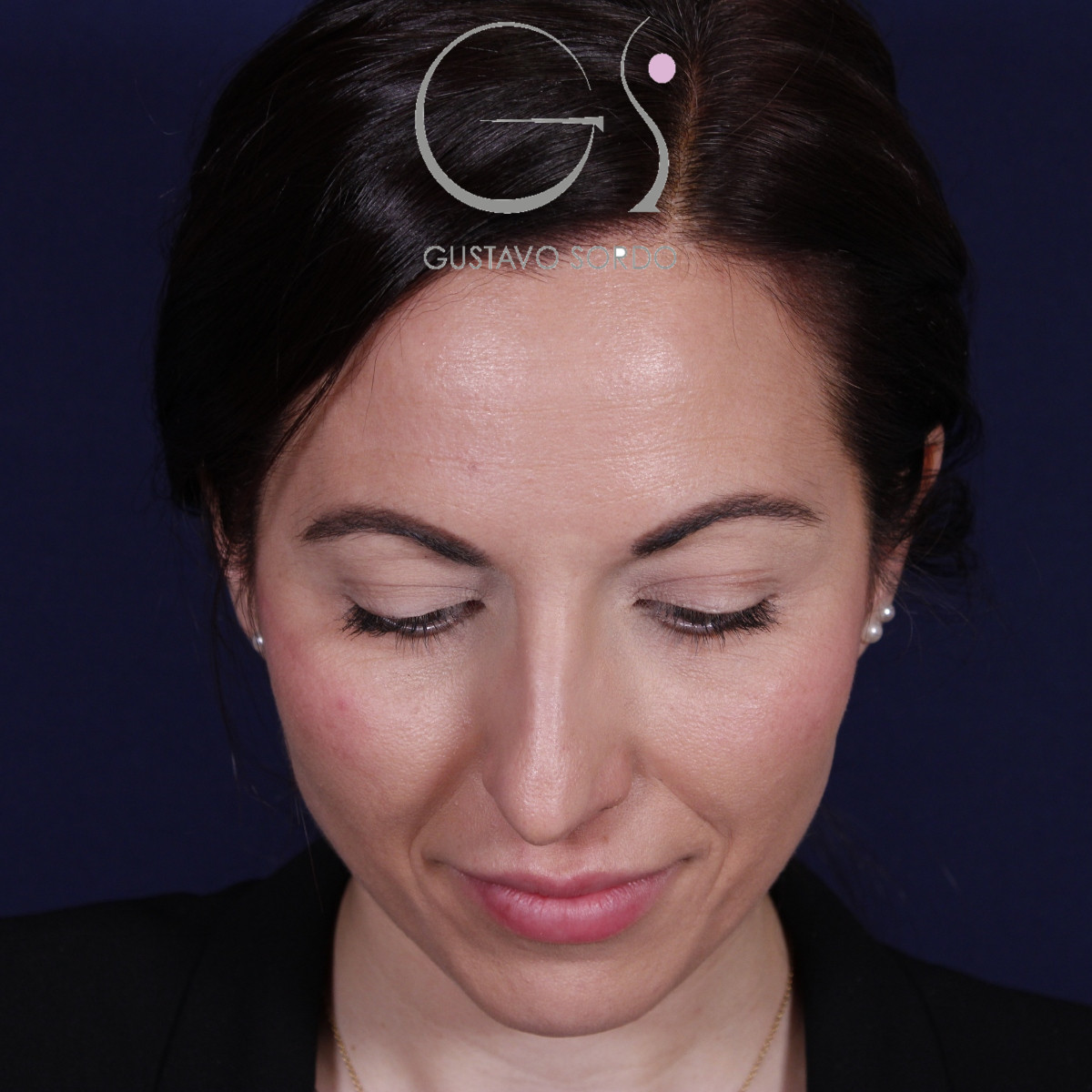 Rhinoplastie ultrasonique réalisée sur un patient — avant l'intervention. Cas opéré par le Dr Gustavo Sordo à Madrid