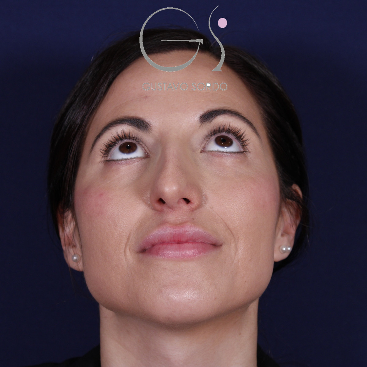 Rhinoplastie ultrasonique réalisée sur un patient — avant l'intervention. Cas opéré par le Dr Gustavo Sordo à Madrid